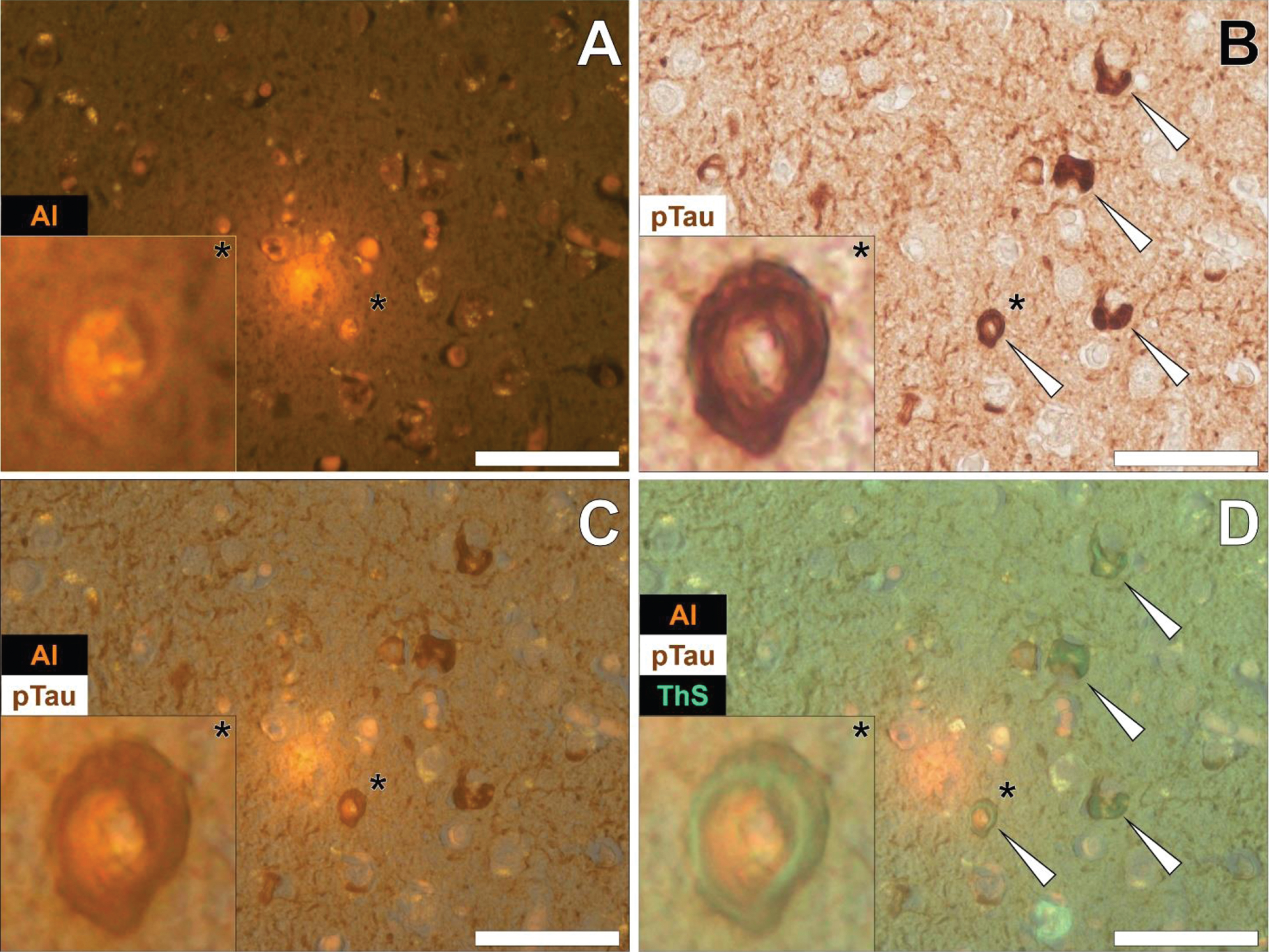 Neuronal cells loaded with aluminum in close proximity to extracellular aluminum in the temporal cortex of a 45-year-old female Colombian donor with familial Alzheimer’s disease. A) Intracellular aluminum (Al) in close proximity to aluminum-rich cellular debris (orange). B) AT8 immunoreactive phosphorylated tau (pTau) in neurons (arrows) located via DAB staining in the identical section (brown). C) Merging of lumogallion and brightfield channels depicting aluminum and pTau in the identical neuron. D) Overlay of thioflavin S fluorescence (green) highlighting NFTs of pTau. Asterisks denote magnified inserts. Figure adapted from [26] under CC license. Magnification: X 400, scale bars: 50μm.