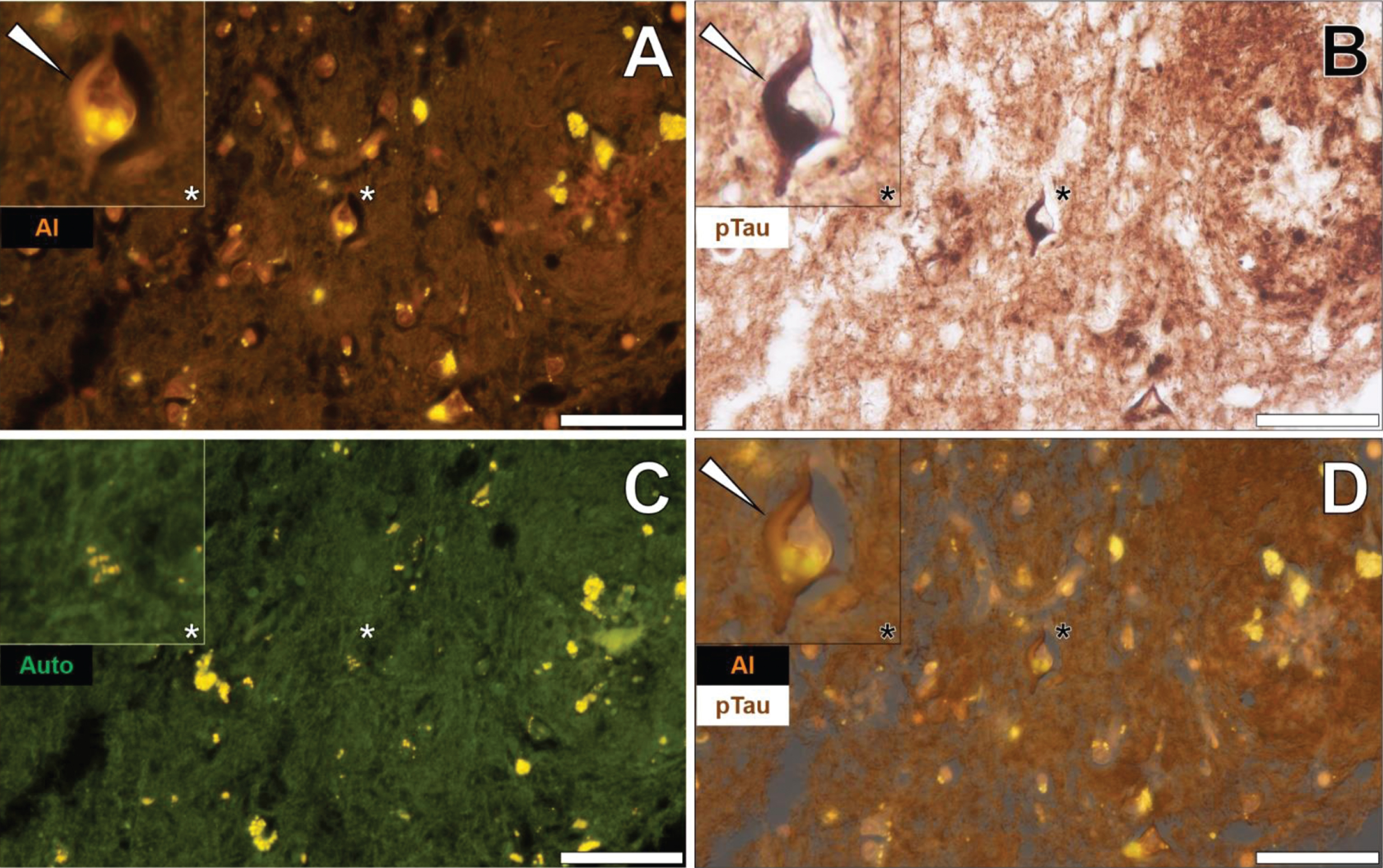 Intraneuronal aluminum in the temporal cortex of a 60-year-old male Colombian donor with familial Alzheimer’s disease. A) Intracellular aluminum (Al) in a neuron (orange). B) AT8 immunoreactive phosphorylated tau (pTau) located via DAB staining (brown) appearing as flame-like NFT. C). Autofluorescence (green) of the non-stained adjacent section highlighting occasional deposits of intracellular lipofuscin (yellow). D) Merging of lumogallion and brightfield channels depicting aluminum and pTau co-localized in the identical neuron. Asterisks denote magnified inserts. Magnification: X 400, scale bars: 50μm.