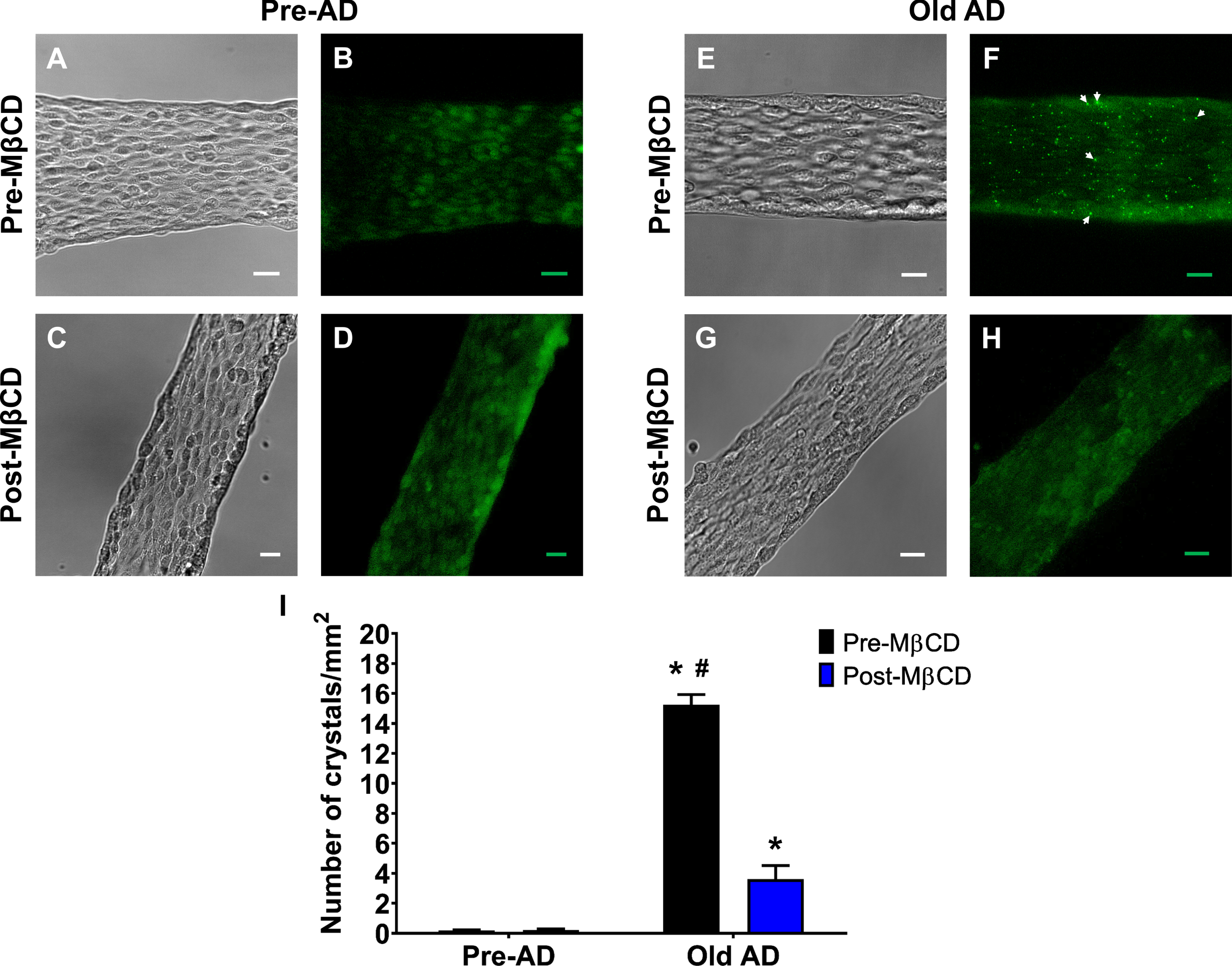 Presence of cholesterol crystals in AD animals and reduction following MβCD treatment. Representative (A, C, E, G) brightfield and (B, D, F, H) Filipin-III images (green pseudo-color) of cerebrovascular endothelial cell tubes isolated from female animals. A, B) Pre-AD images without MβCD treatment. C, D) As shown in (A) & (B) respectively after MβCD treatment (1 mmol/L, 20 min incubation, & 1 h wash). E-H) As shown in (A), (B), (C), and (D) respectively for AD animals. White arrows indicate cholesterol “crystals” in endothelial tubes during AD conditions in the absence of MβCD treatment. The scale bar throughout panels represents 20μm. I) Summary data for number of crystals per unit area (mm2). n = number of animals and respective cerebral endothelial tubes (Pre-AD & Old AD: 4; Pre-AD & Old AD after MβCD: 3). *p < 0.05 (two-way ANOVA & paired t-test), Pre-AD or Old AD female Post-MβCD versus respective Pre-MβCD group; #p < 0.05 (two-way ANOVA & paired t-test), Old AD female Pre-MβCD versus Old AD female Post-MβCD.