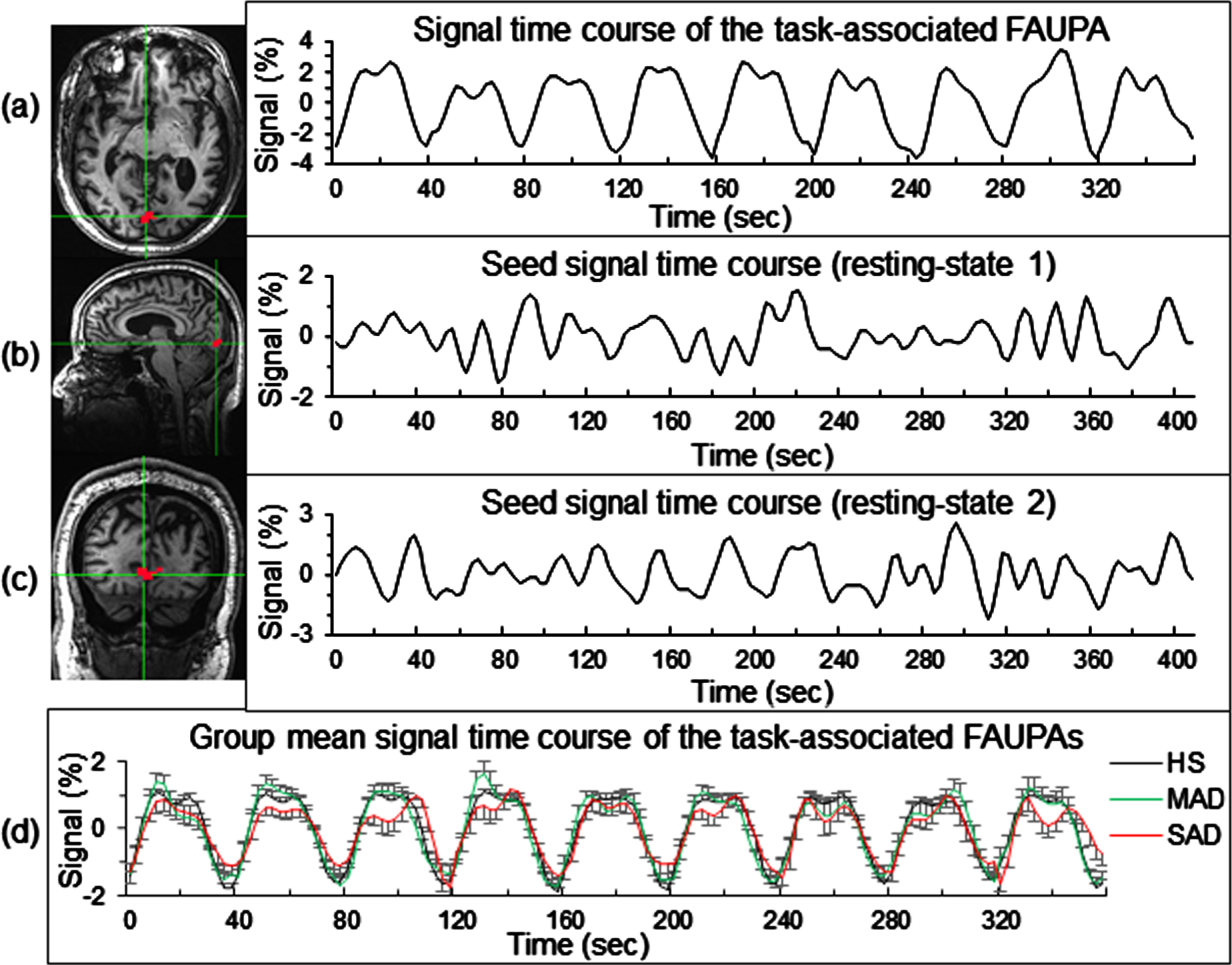 Illustration of the selected task-associated FAUPA for a representative SAD patient and using this FAUPA as seed to conduct a seed-based visual functional connectivity analysis for the resting-state data. The red clusters in the three images represent the selected task-associated FAUPAs in the putative V1, identified with the task-fMRI data for the unfamiliar face category [32]. The FAUPA’s signal time course was the mean signal time course averaged over that of all voxels within the FAUPA (a). Task-induced, time-locked signal changes are conspicuous for each of the nine task trials. The two plots in (b) and (c) show the seed-mean signal time courses for the two resting-state time series, respectively. (d): Comparison of the group-mean signal time courses of the selected FAUPAs for the three participant groups. HS, healthy senior; MAD, mild/moderate AD; SAD, severe AD. The error bar indicates the standard error of the means.