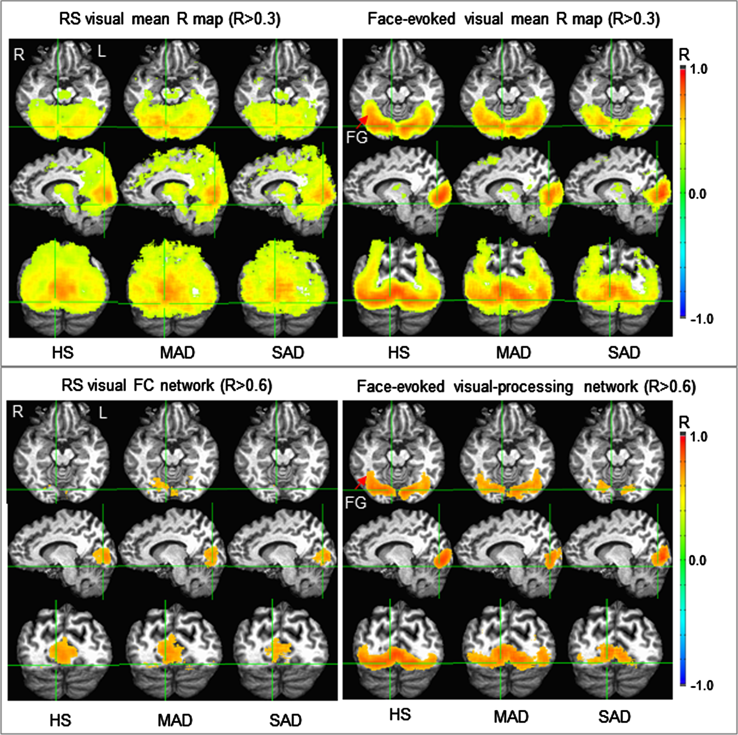 Illustration of the two visual group-mean R maps identified for the three subject groups (top panel) and their corresponding functional networks (bottom panel). (Note that these R maps were thresholded with R >  0.3 for better visual comparison between the resting and task states.) The face-evoked visual-processing network was mainly confined within the visual cortex for the severe AD (SAD), but extended to the fusiform gyrus (FG) for the healthy senior (HS) controls and mild/moderate AD (MAD). In contrast, the resting-state visual functional connectivity (FC) network was located mainly within and around area V1 for the SAD patients, but substantially extended for the MAD patients and HS controls.