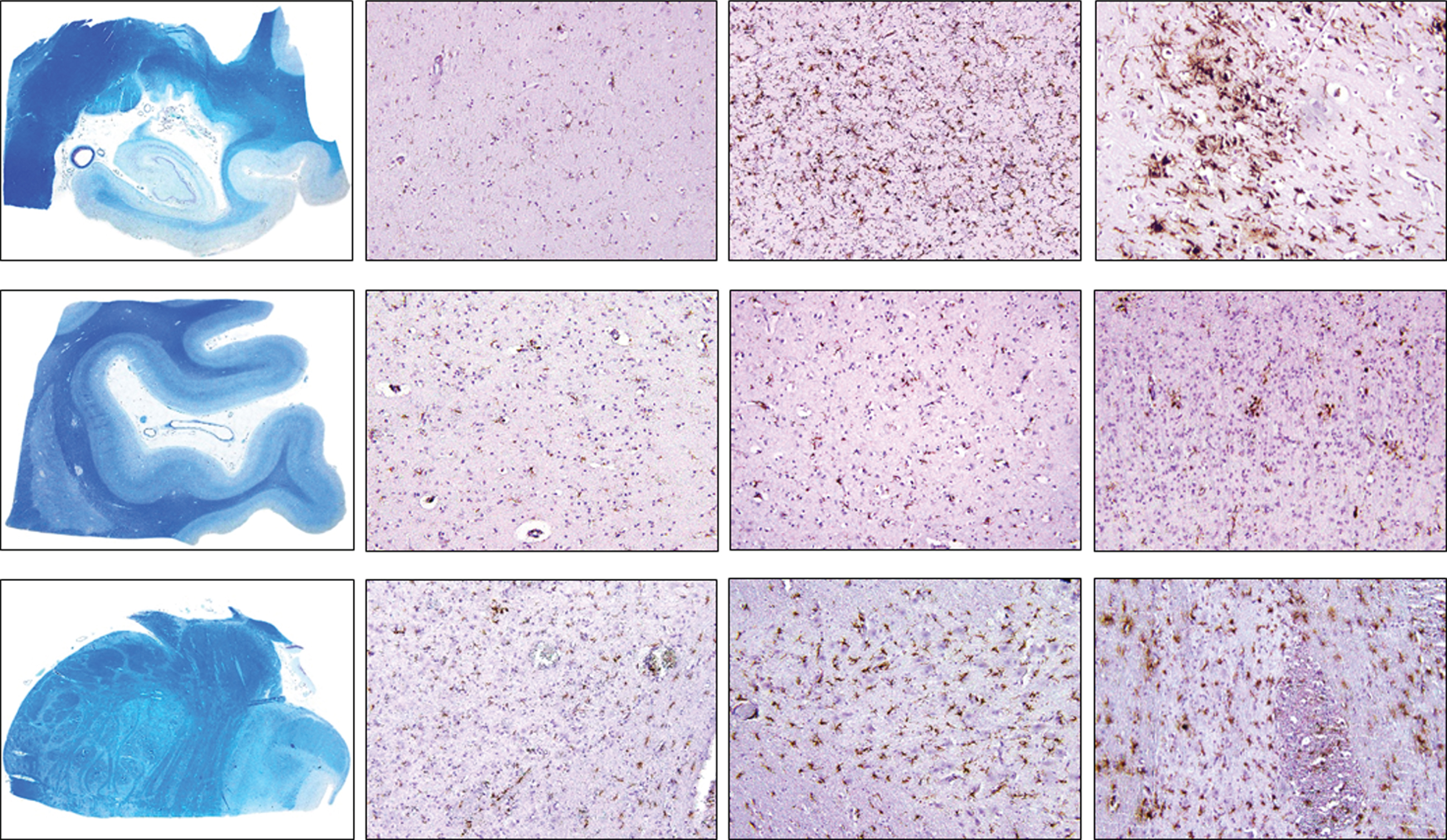Density of CD68-positive cells in control, intermediate and late AD, respectively (upper row, hippocampus; middle row, occipital cortex, lower row, brainstem) (magnification 100x).