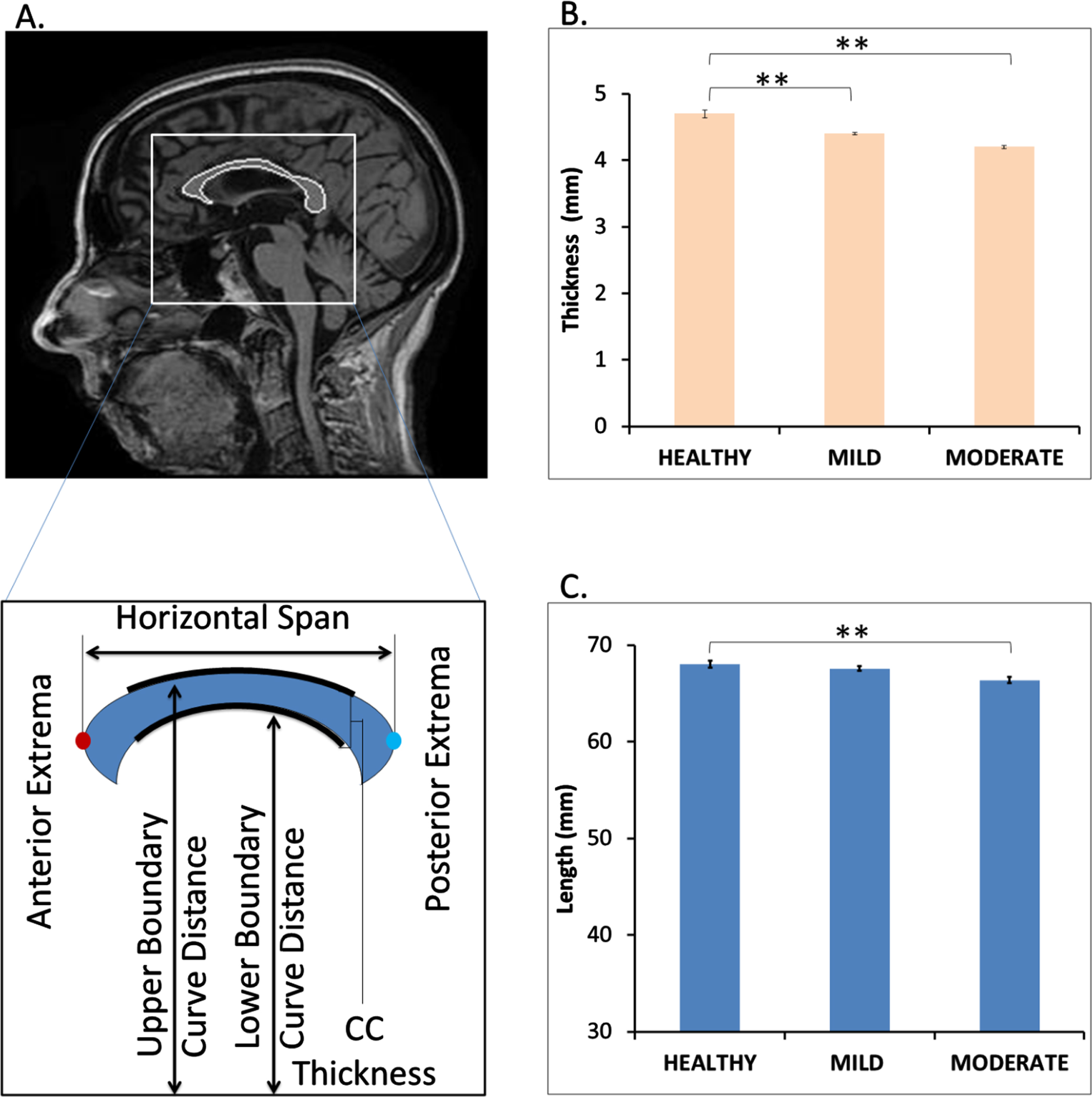Decrease in corpus callosum (CC) length and thickness in mild and moderate dementia patients. Panel A shows a sample mid sagittal view of the segmented CC from healthy person MRI. It also provides a pictorial depiction of the measurement of CC length (horizontal span) and thickness. Panel C and D compares the average CC thickness and length among healthy, mild, and moderately demented samples. p < 0.05 is signified by ** symbol.