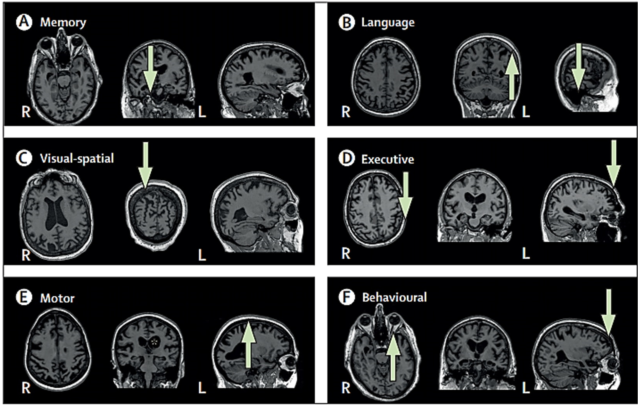 MRI across Alzheimer’s disease phenotypes. A) Memory (typical amnestic); arrow indicates hippocampal atrophy. B) Language (logopenic variant primary progressive aphasia); arrows highlight left temporal-parietal atrophy. C) Visual-spatial (posterior cortical atrophy); arrow indicates parieto-occipital atrophy. D) Executive (also known as dysexecutive); arrows indicate frontoparietal atrophy. E) Motor (corticobasal syndrome); asterisk highlights greater left than right hemisphere atrophy, and arrow indicates atrophy around the motor cortex. F) Behavioral; arrows point to greater temporal than frontal atrophy. R, right; L, left. Reprinted from Lancet Neurology, Vol 20, Graff-Radford et al., New insights into atypical Alzheimer’s disease in the era of biomarkers, 222–234, 2021 [69], with permission from Elsevier.