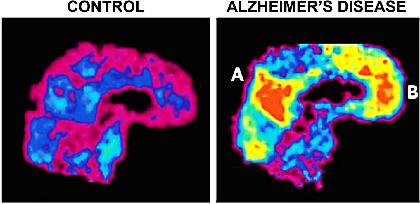 Amyloid deposition in Alzheimer’s disease. PET images of the medial surface show retention of Pittsburg Compound-B (PIB), an amyloid-imaging tracer, in a normal control subject (Left) and an individual with Alzheimer’s disease (Right). PIB retention is prominent in posterior parietal regions near posterior cingulate and retrosplenial cortex (A) and in frontal cortex (B). The presence of substantial amyloid burden in posterior regions that overlap memory networks, as shown in Fig. 2, suggests a mechanism by which amyloid toxicity might disrupt memory. Correspondence among regions showing retrieval success effects, metabolism difference in Alzheimer’s disease, and amyloid burden extends to lateral parietal regions (data not shown) as well as to measures of cortical atrophy (e.g., see [74]). Reprinted from Neuron, Vol 44, Buckner, Memory and executive function in aging and AD: multiple factors that cause decline and reserve factors that compensate, 195–208, 2004 [24], with permission from Elsevier.