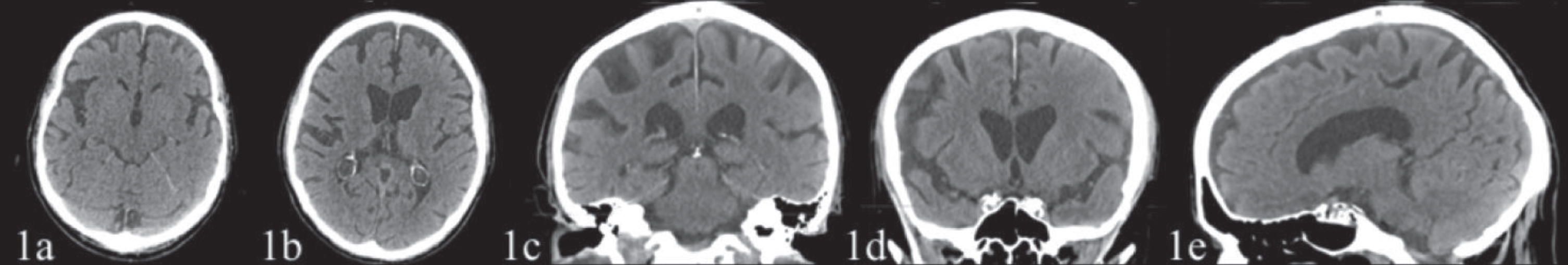 CT scan (February 17, 2018), with no contrast, showing a posterior parietal (1c, 1d) and temporal cortical atrophy (1a) prevalent on the right hemisphere and a moderate atrophy of the precuneus (1e) and frontal cortex (1a, 1b). The hippocampus and the mesial temporal area appeared fairly preserved.