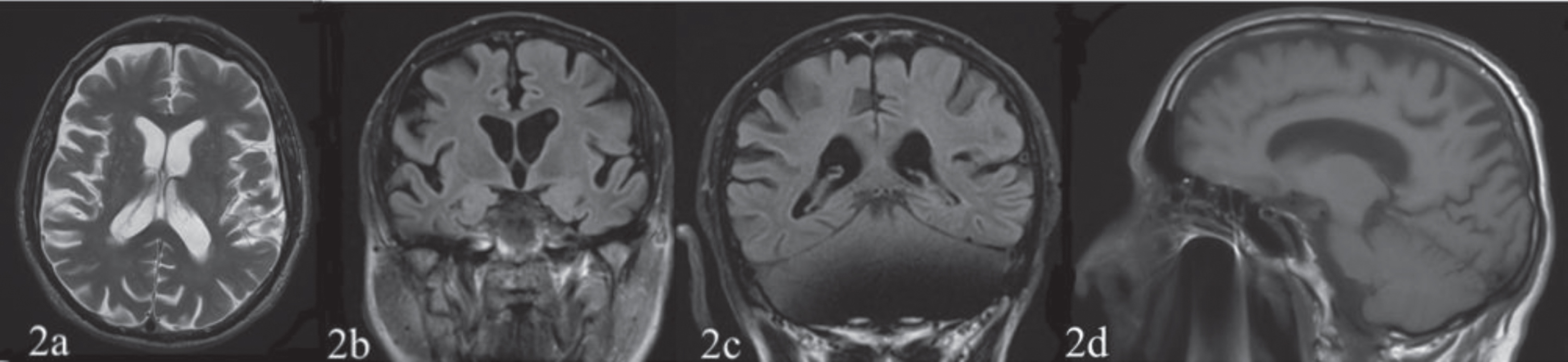The first (March 3, 2018) and the second (December 14, 2019, not showed) structural MRI T1 and T2 weighted sequences reported a posterior parietal (2b, 2c), temporal (not shown) and frontal cortex (2a) atrophy prevalent on the right hemisphere and an atrophy of the precuneus (2d).