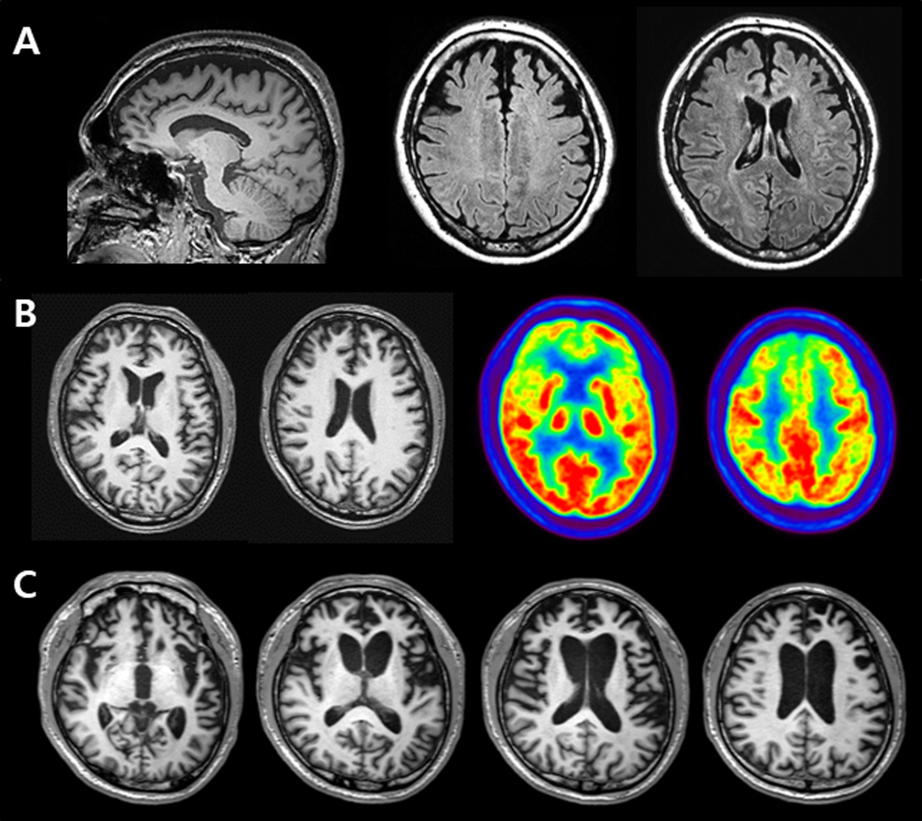 A) Brain MRIs of FTD-18 who carried variant p.G706R of the MAPT gene, revealing bilateral and symmetric frontal atrophy. B) Brain MRIs and FDG-PET images of FTD-13 who carried variant M232R of the PRNP gene, showing cortical atrophy and severe glucose hypometabolism in the bifrontal areas. C) Brain MRIs of FTD-39 who carried variant M232R of the PRNP gene, demonstrating prominent bilateral frontotemporal atrophy, worse on the left.