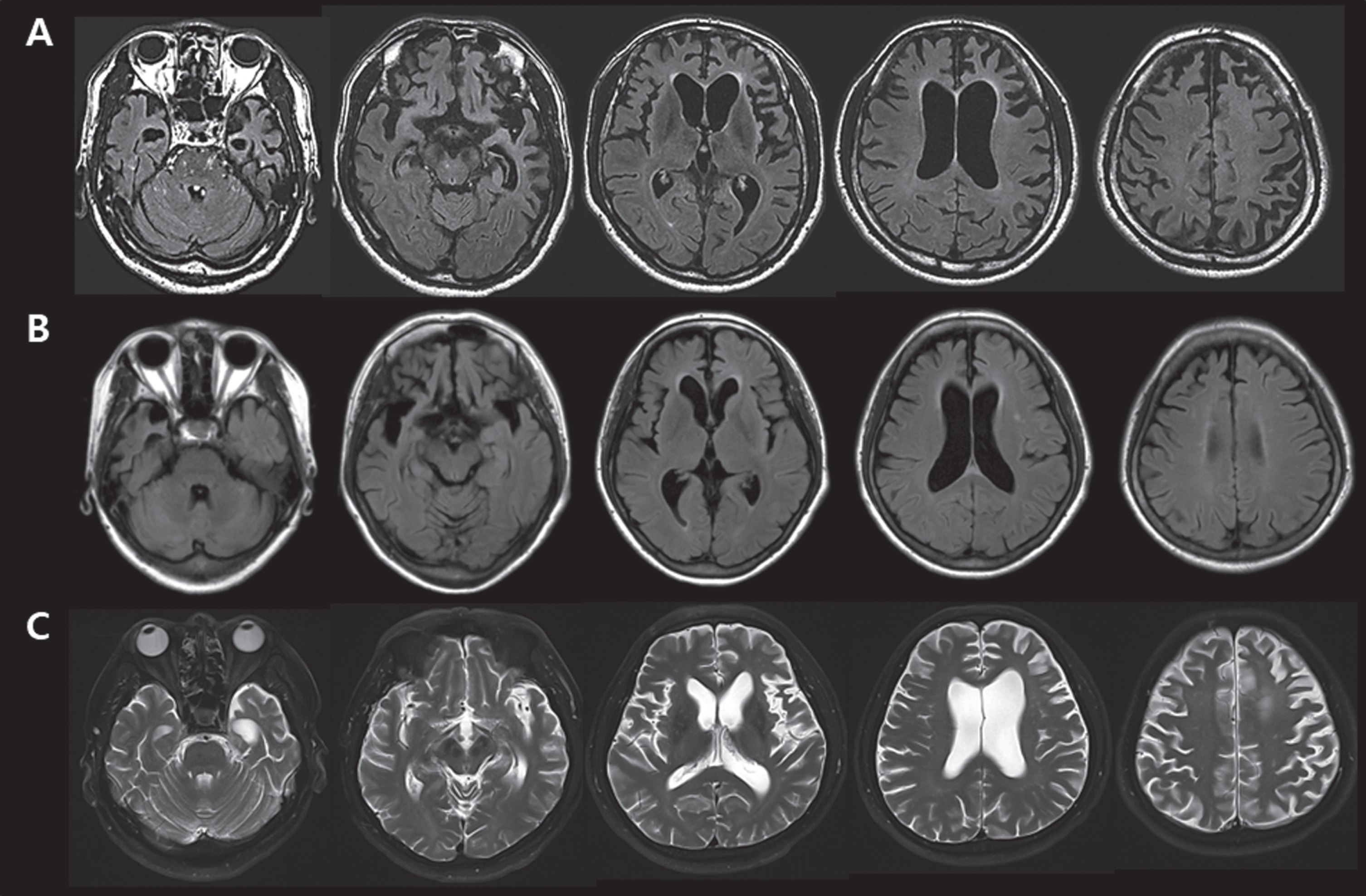 A) Brain MRIs of FTD-36 who carried variant p.R93L of the VCP gene, showing bi-frontotemporal atrophy (worse on the left) and left parietal atrophy. B) Brain MRIs of FTD-48 who carried variant p.S7N of the UBQLN2 gene, variant p.T421M of the PSEN2 gene and variant p.G638S of the GALC gene, revealing right asymmetric frontotemporal atrophy. C) Brain MRIs of FTD-61 who carried variant p.L136S of the APP gene, demonstrating prominent atrophy in the bifrontal and left temporal area.