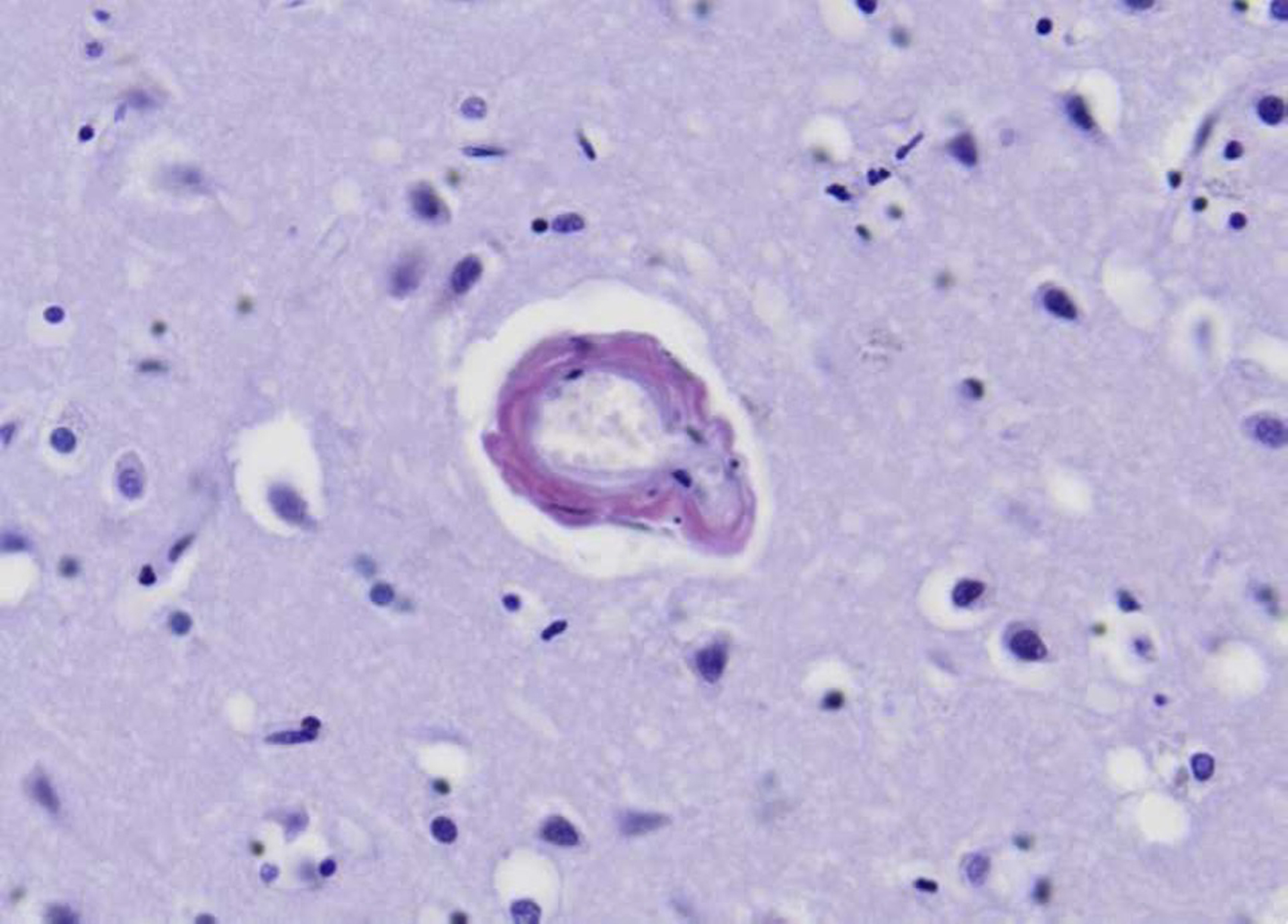 Amyloid special stain showing vascular amyloid deposition in a cortical leptomeningeal vessel with preservation of some vascular smooth muscle cells, corresponding to CAA grade 1. Note the vascular microaneurysm.