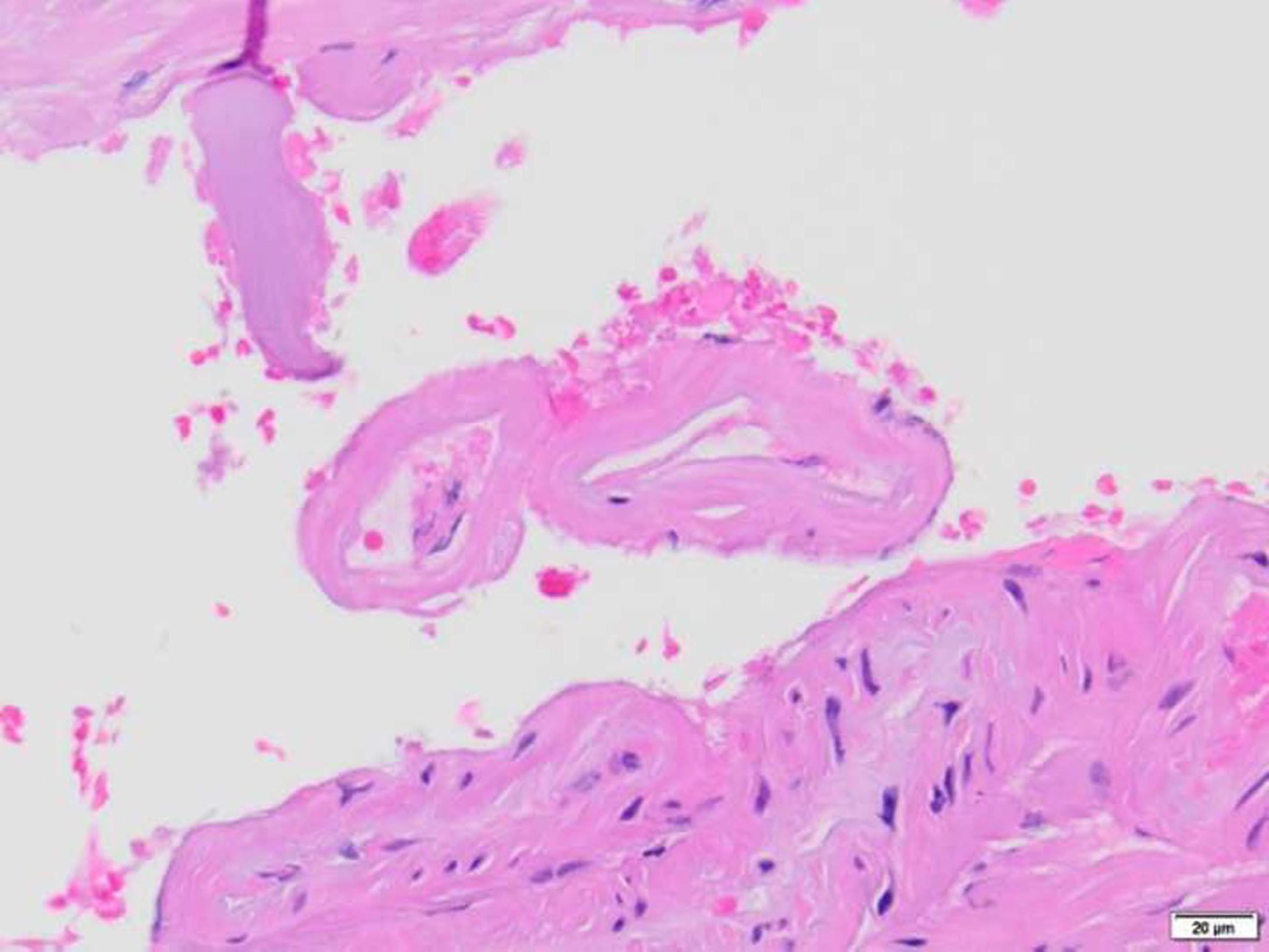 Leptomeningeal vascular biopsy in patient with suspected CAA showing complete replacement of vascular wall by homogenous eosinophilic amyloid categorized as CAA Grade 2. Confirmed by amyloid-ʲ immunohistochemistry (not shown). Hematoxylin and Eosin, 400x.
