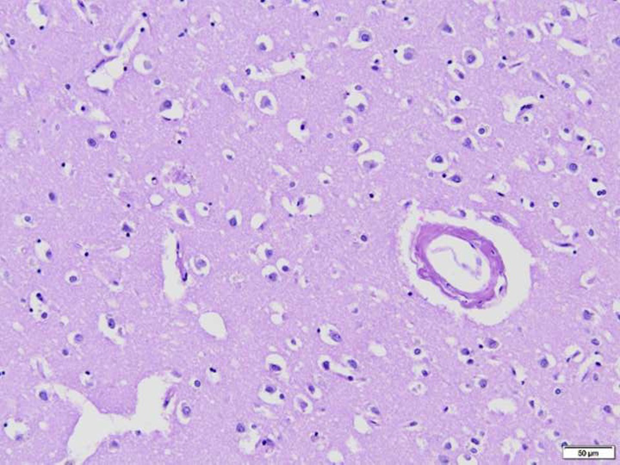 Plaque and blood vessel with amyloid deposition. Hematoxylin and Eosin, 200x.