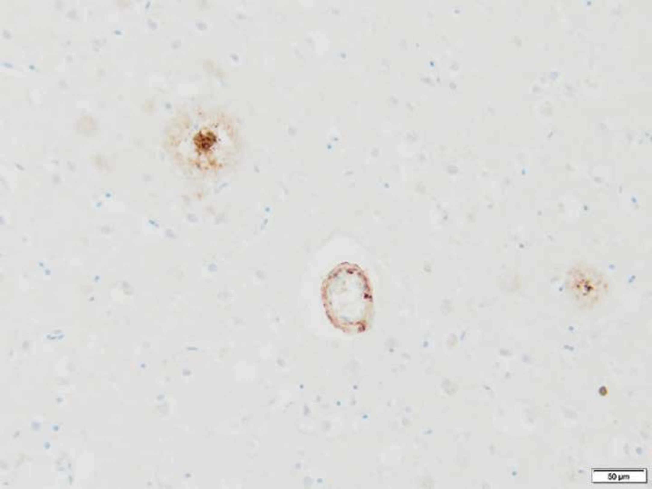 Immunohistochemical stain highlighting cortically localized amyloid-ʲ plaques and vessel wall amyloid-ʲ deposition in Alzheimer’s disease (amyloid-ʲ ICH, 200x).