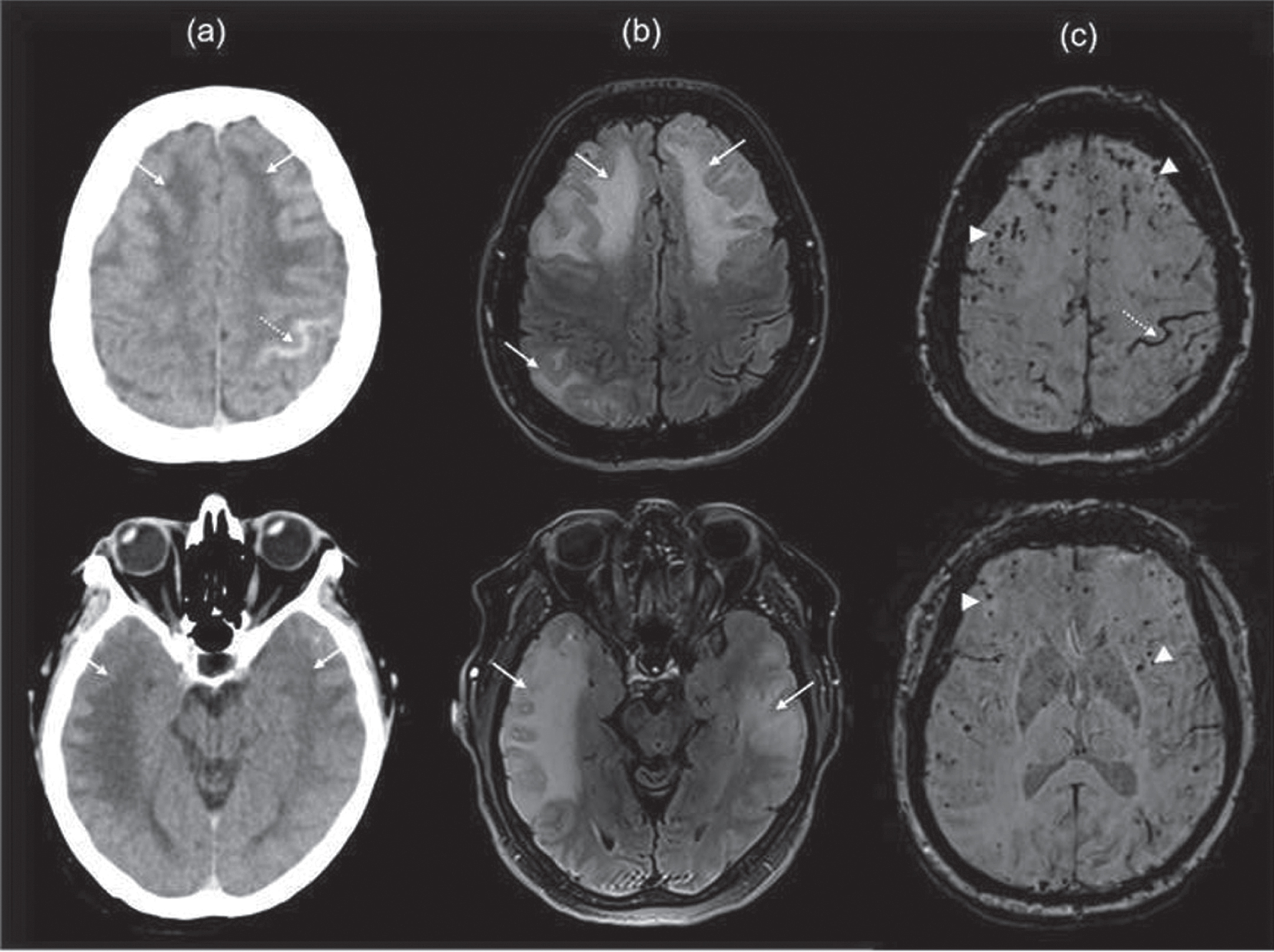 Radiographic findings in 65-year-old-woman presented with TFNE secondary to CAARI with microhemorrhages. Notes: Axial non-contrast CT scan of the head (a), axial MRI T2-FLAIR (b), and SWI sequence (c) show a pattern of inflammatory CAA with diffuse vasogenic edema involving predominantly the frontal, parietal, and temporal lobes (white arrows) resulting in effacement of adjacent sulci; there are associated multiple foci of petechial microhemorrhages (double arrows) and acute subarachnoid hemorrhage in the left central sulcus (dotted arrow).