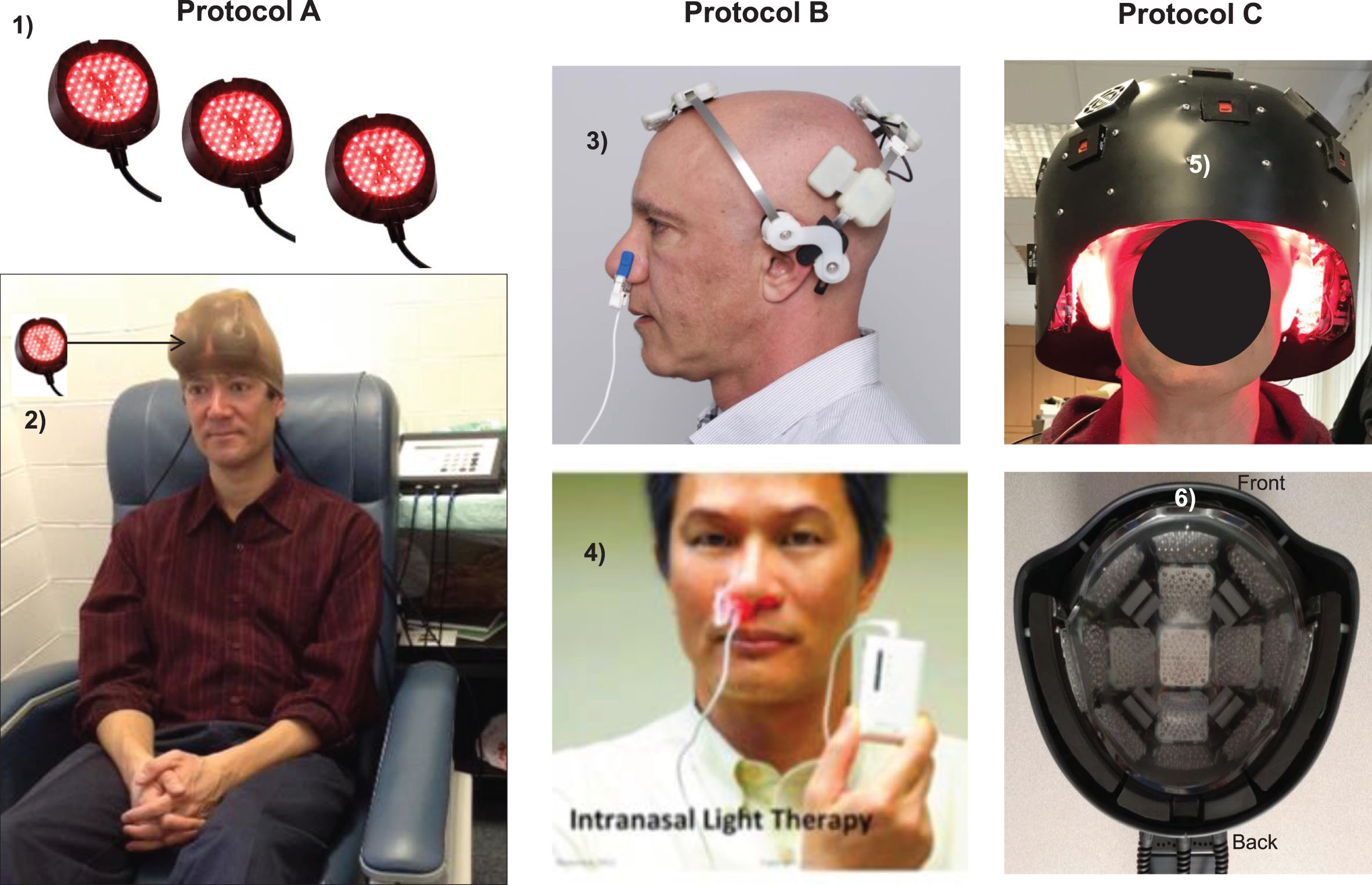LED devices used for tPBM Protocols A, B, and C. Protocol A: In-office treatments with red/NIR, LED cluster heads (1); two sets of six, LED cluster heads were held in place with a soft, breathable, nylon cap (arrow, 2), MedX Health, Inc., Canada. Supplementary Table 2 lists all LED parameters. Protocol B: At-home treatments with single, NIR diodes (810 nm, pulsed 40 Hz) placed on scalp only over cortical nodes, Default Mode Network, including a single, NIR intranasal applicator directed towards olfactory bulbs to indirectly treat connections with hippocampal areas (3), Neuro Gamma device; plus a separate, red intranasal diode (4), Vielight, Inc., Canada. Not necessary to shave the head. Additional home treatment information is in Supplementary Text Material 2. Protocol C: In-office treatment with a helmet (5), lined with red/NIR, LED cluster heads placed in rows inside the helmet (6), THOR Photomedicine, Ltd., UK. NIR, near-infrared. Permissions: Protocol A, (2) reprinted with authors’ permission from [59]. Protocol B, (3) and (4) reprinted with permission from Vielight, Inc., in the public domain.