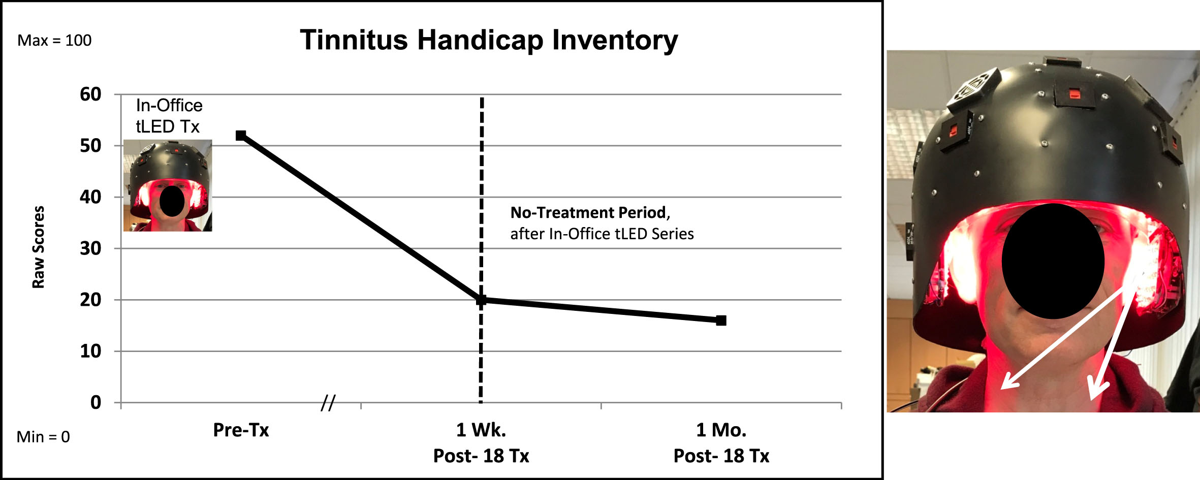 P3, Tinnitus Handicap Inventory. The severe tinnitus ratings on the THI were reduced at 1 week, and at 1 month after the in-office series. White arrows suggest that the red/NIR photons reached sides of the neck with the LED-lined helmet (Protocol C). The NIR photons likely reached the left and right stellate ganglion areas, a target for NIR photons to reduce tinnitus [91]. THI, Tinnitus Handicap Inventory.