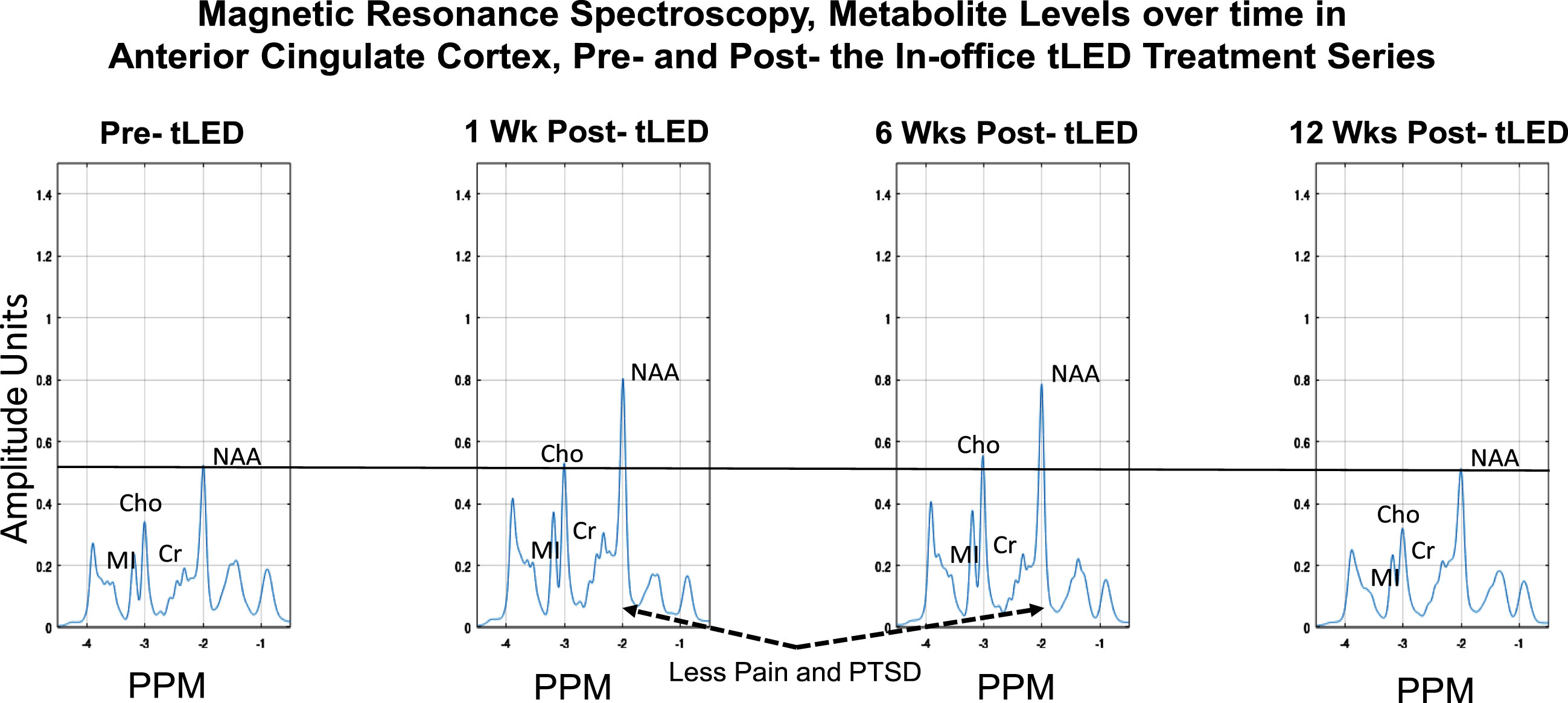 P2, MRS results for metabolite levels in anterior cingulate cortex over time, pre- /post- the initial, in-office tPBM series (Protocol C). Increased NAA (a correlate of oxygen consumption in mitochondria) was present at 1 week and 6 weeks after the in-office tPBM series, but not at 12 weeks, when NAA returned to pre-treatment level. P2 had rated less pain and PTSD at 1 week and 6 weeks; however, these self-ratings returned towards, or at pre-, at 12 weeks (Fig. 3B, graphs a and c). The PTSD and pain ratings again improved after the at-home tLED series. No MRS data are available then, due to COVID restrictions. MRS, magnetic resonance spectroscopy; NAA, n-acetyl-aspartate; MI, myo-inositol; Cho, choline; Cr, creatine; PPM, parts per million; PTSD, post-traumatic stress disorder.