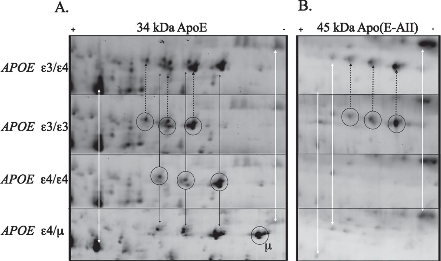 Large format 2D gel (pH range 4.7–5.9) comparing the ApoE proteins from different genotypes. ApoE protein has three main groups of protein isoforms (circled, A). The white arrows indicate representative non-apoE “landmark” spots, showing that there is no appreciable pI shift between the gels. Comparison of and ɛ3 and ɛ4 carriers demonstrates the well know shift in isoelectric point between different apoE forms as well as the shift introduced by the missense mutation of cys to arginine. The additional mutation of Q222K (μ) induces a basic shift of similar magnitude as the cys to arg mutation. ApoE ɛ2 and ɛ3 protein variants are known to form a 45 kDa complex with apoAII:Aβ. This complex is present in the ɛ3 carriers but not in the Q222K (ɛ4/μ)carrier (B).