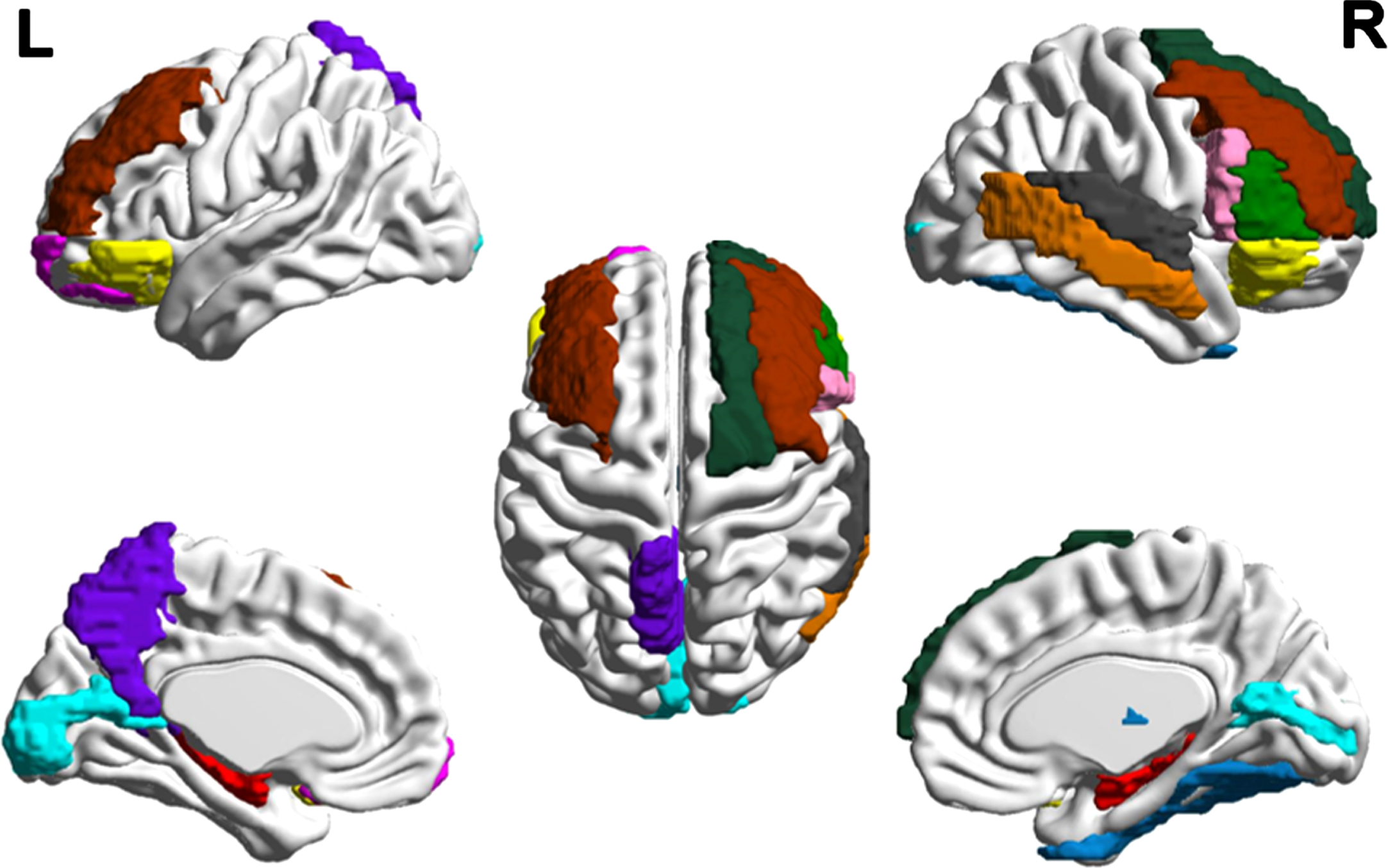 Distribution of cortical changes in COPD patients. Compared to the normal controls, cortical atrophy in COPD patients is concentrated in bilateral hippocampus (red), right opercular part (pink)/triangular part of the inferior frontal gyrus (green), left precuneus (purple), bilateral middle frontal gyrus (brown), right thalamus (blue), right superior (gray)/middle temporal gyrus (orange), right superior frontal gyrus (blackish green), bilateral calcarine (cyan), bilateral orbital inferior frontal gyrus (yellow), left orbital superior frontal gyrus (magenta), and right fusiform gyrus (indigo). Compared with the dominant hemispheres, the structural changes in the non-dominant hemispheres were more obvious. The lesions in the frontal lobe are prominent.
