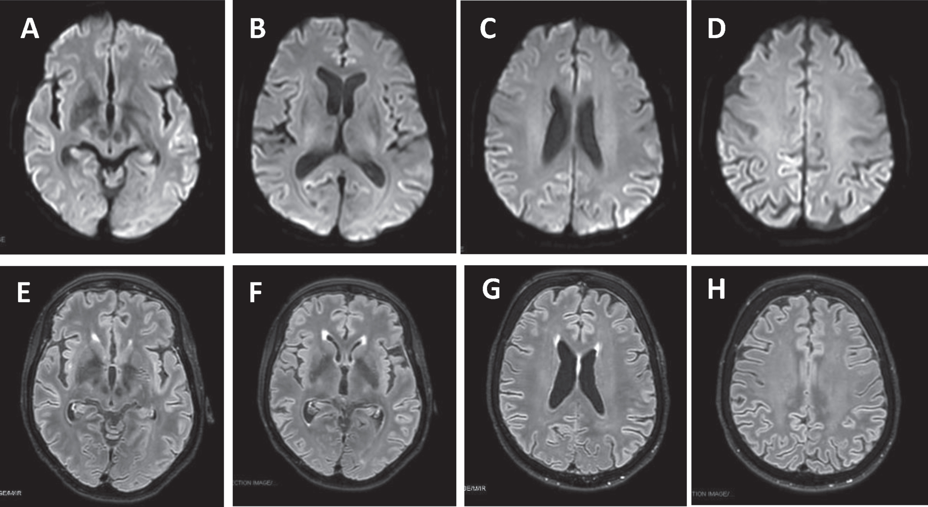 Brain MRI DWI showed cortical ribboning of the frontal, parietal, temporal, and insular regions (A-D) that corresponded to hyperintensity in FLAIR sequences (E-H).