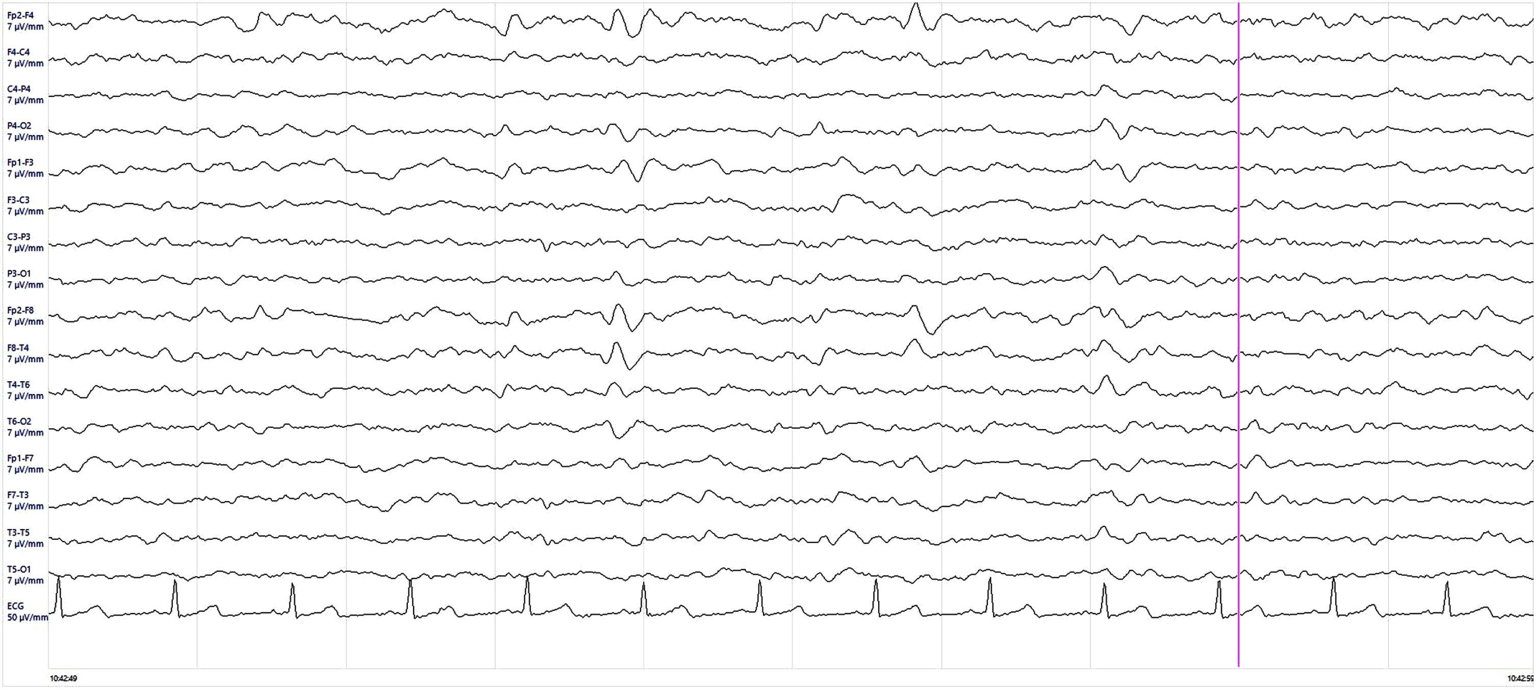 Electroencephalogram (EEG) findings. EEG showed rare quasi-periodic right frontotemporal sharp wave complexes.