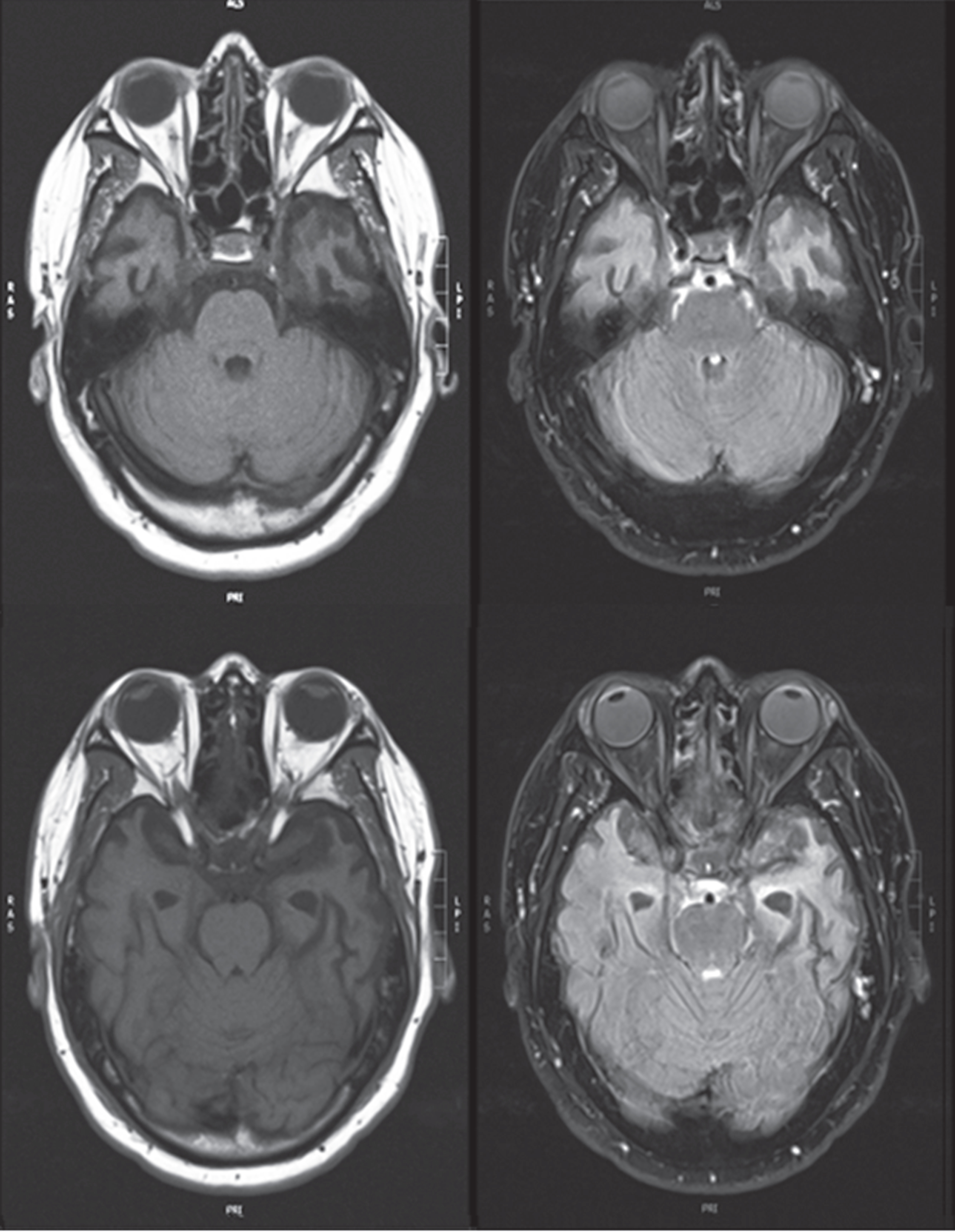 Magnetic resonance imaging (T1-weighted axial images on left and corresponding FLAIR images on right) showing anterior temporal atrophy involving temporal poles, more prominently on the left. Informed consent for images obtained.