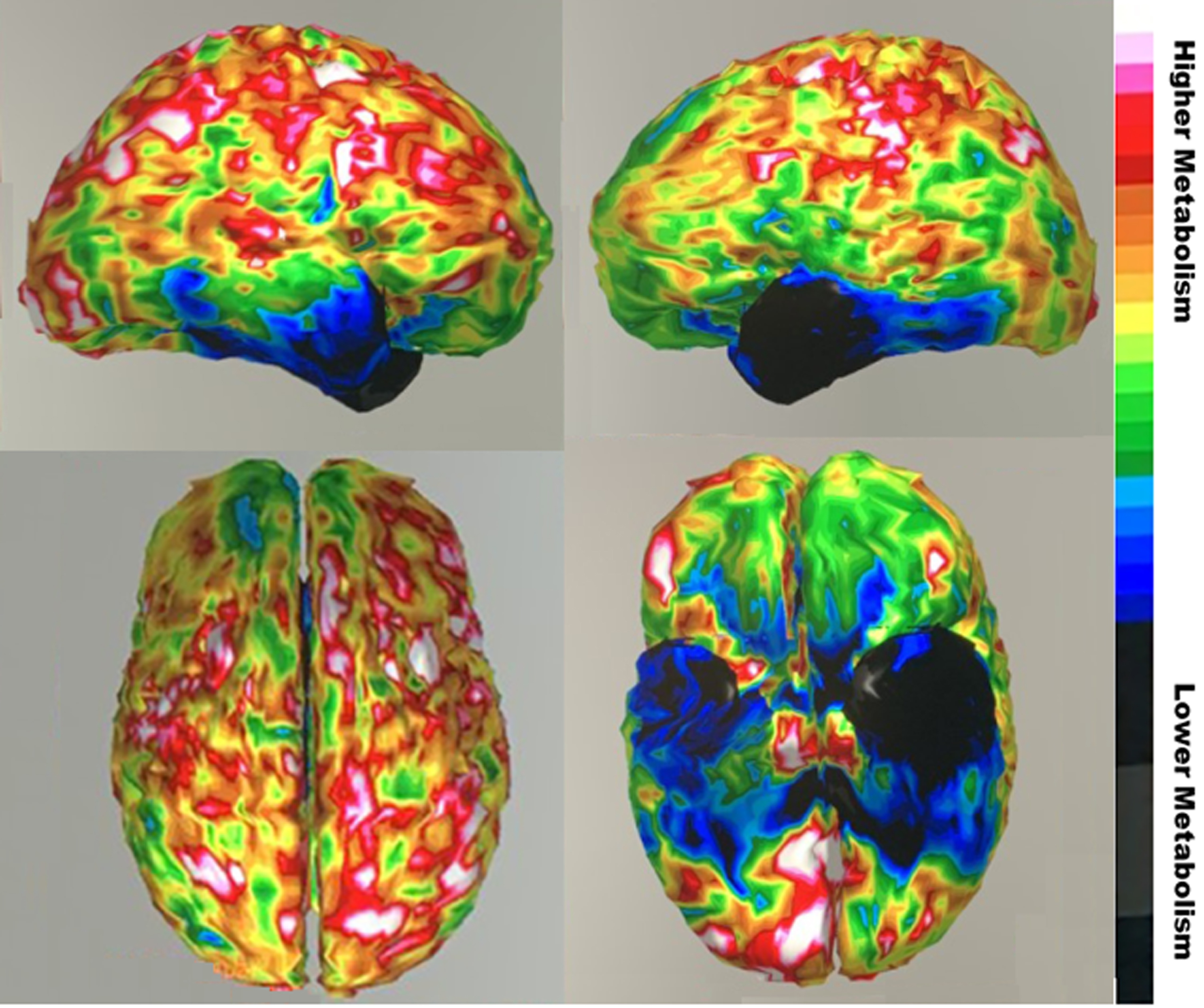Fluorodeoxy-glucose positron emission tomography (FDG-PET) images showing severe hypometabolism (blue region) in anterior temporal regions, worse on left, with somer extension into the inferior frontal region. (Top sagittal view right hemisphere on left and left hemisphere on right; color bar indicates degree of metabolism). Informed consent for images obtained.
