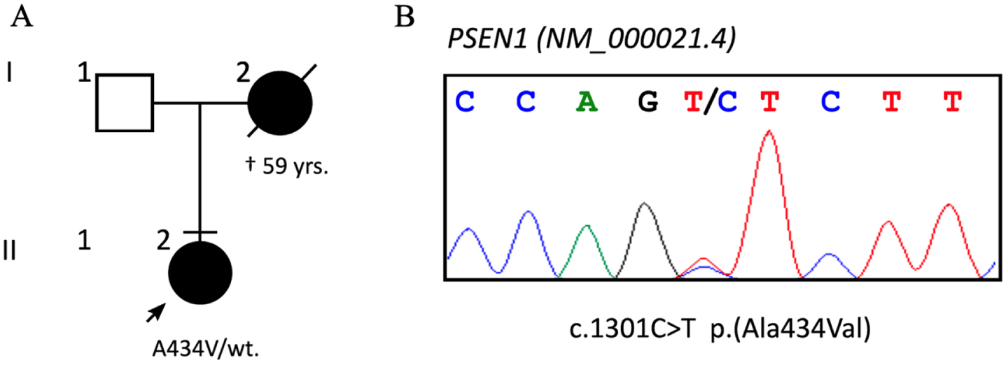 A) Patient’s family tree, with known cases of dementia blacked and deceased barred; the arrow points to the proband. B) Sanger sequencing confirmed the heterozygous c.1301 C>T variant.