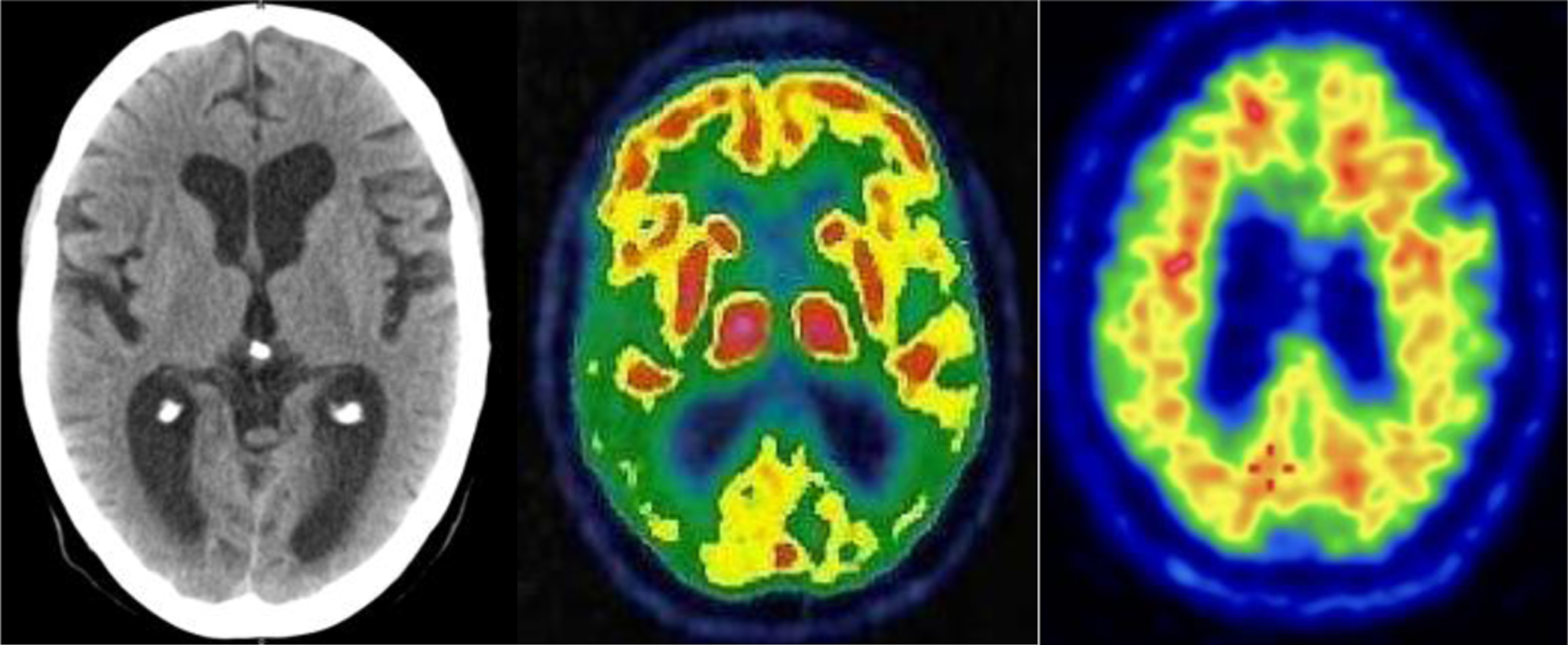 Neuroimaging findings. From left to right: CT, FDG-PET, and Amyloid PET with flutemetamol of the patient consistent with the diagnosis of PCA due to AD.