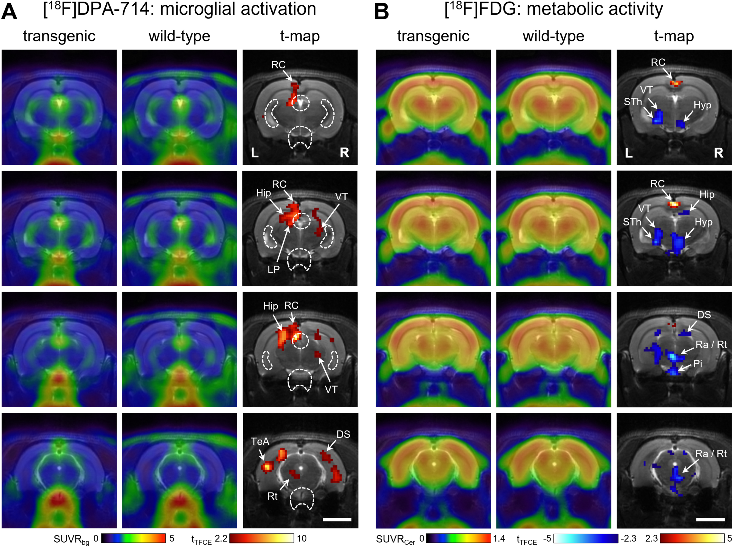 
PET imaging. Shown are averaged PET images of (A) microglial activation measured with [18F]DPA-714 (6 transgenic and 6 wild-type rats) and (B) glucose metabolism measured with [18F]FDG (5 transgenic and 6 wild-type rats). Respective t-maps show significant differences (corrected for multiple testing) between groups. Red voxels: higher tracer uptake in transgenic rats. Blue voxels: higher tracer uptake in wild-type rats. White dashed lines in A indicate regions obscured by spillover from the ventricular system and pituitary gland, where natural TSPO expression leads to high tracer binding. DS, dorsal subiculum; Hip, hippocampus; Hyp, hypothalamus; LP, lateral posterior thalamus; Pi, pituitary gland; Ra, raphe; RC, retrosplenial cortex; Rt, reticular formation; STh, subthalamic nucleus; TeA, temporal association cortex; VT, ventral thalamus. Scale bar: 5 mm.