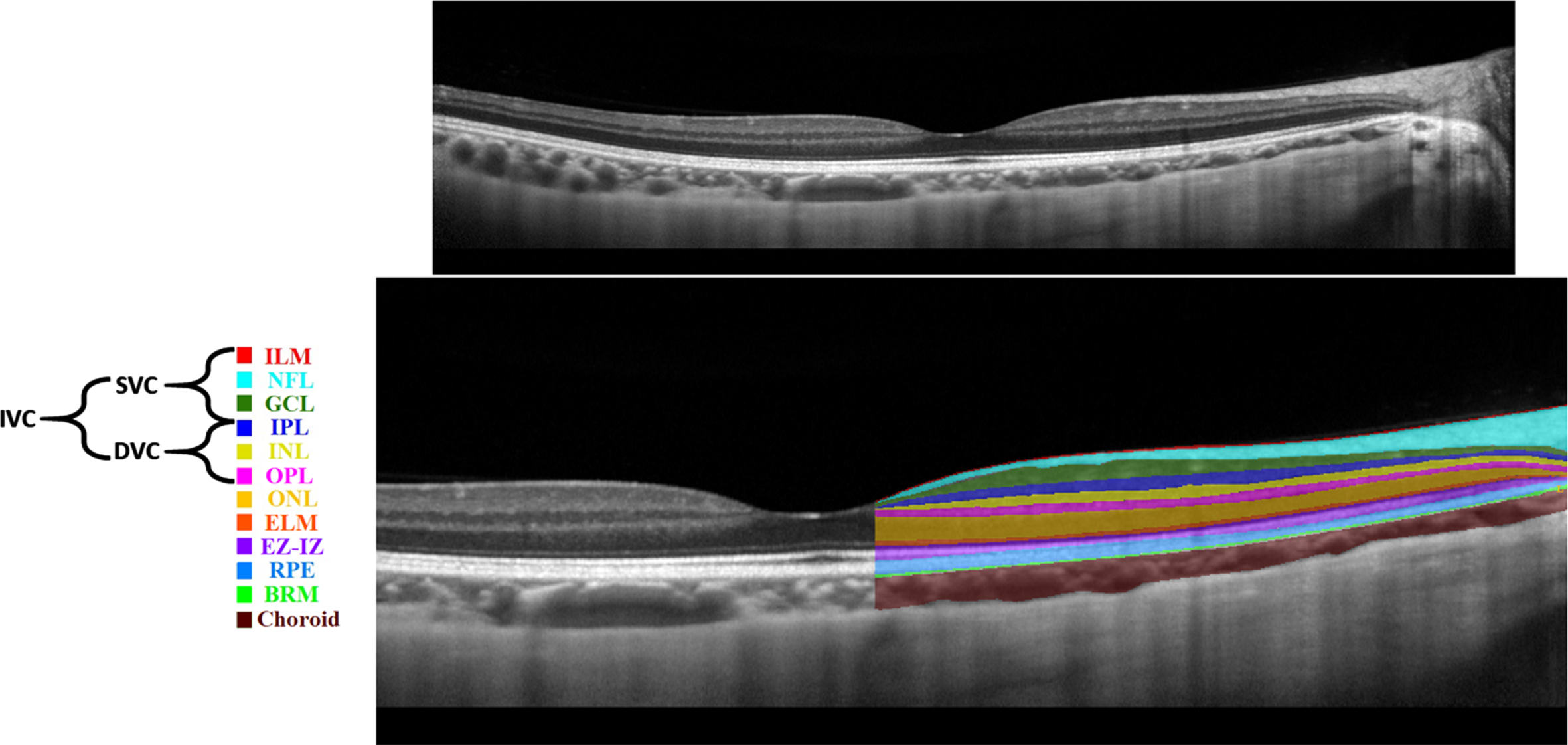 Retinal layers in a spectral domain optical coherence tomography b-scan image: unlabeled (top), labelled (bottom).
