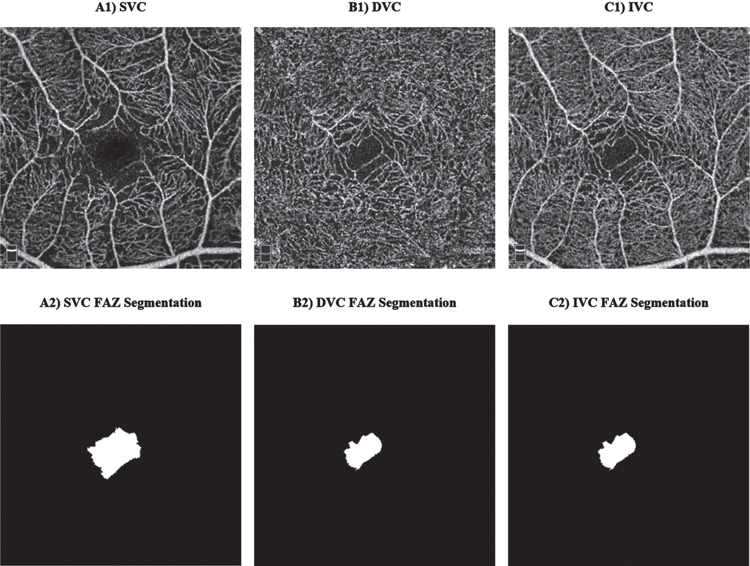 Examples of optical coherence tomography angiography (OCTA) scans: A1) superficial vascular complex (SVC), B1) deep vascular complex (DVC), C1) inner vascular complex (IVC), and their corresponding manual foveal avascular zone (FAZ) segmentation.