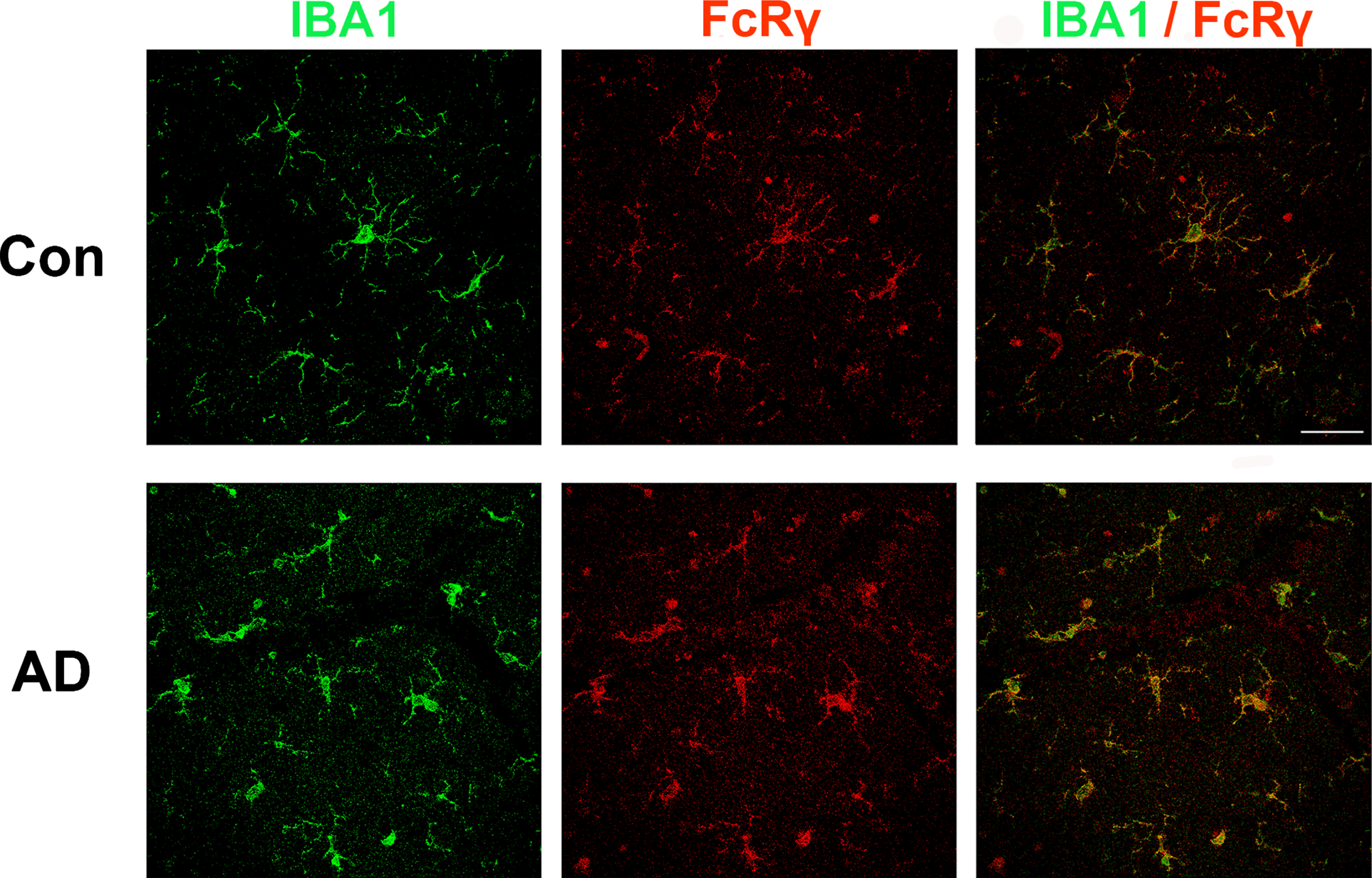 FcRγ and IBA1 co-expression in human brain. Brains sections from individuals with or without AD were immunolabeled for IBA1 (green) and FCER1G (red). The merged image at the right shows that cells labeled by FcRγ are also labeled by IBA1, consistent with the concept that FcRγ is primarily expressed by microglia in the brain. Scale bar = 50μm.