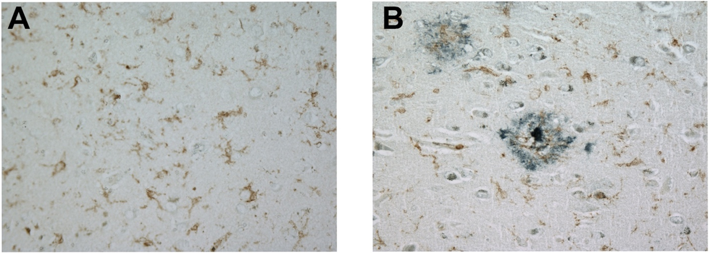 FcRγ is expressed robustly in a non-AD brain in the absence of amyloid plaques (A) and in an AD brain in the presence of amyloid plaques (B). These representative images were obtained with a 40× objective. Brown label represents FcRγ staining while blue-black label represents amyloid-beta staining.