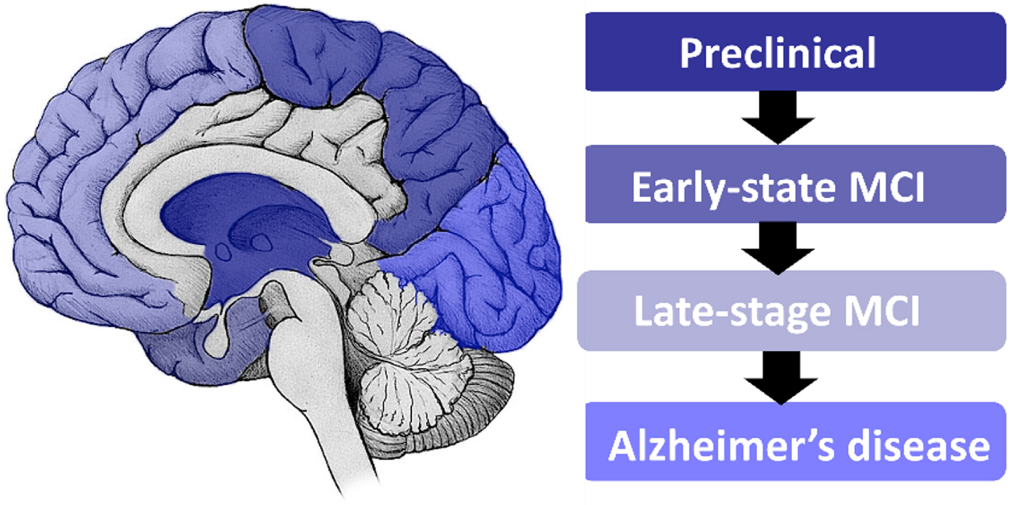 The progression stage of Alzheimer’s disease.