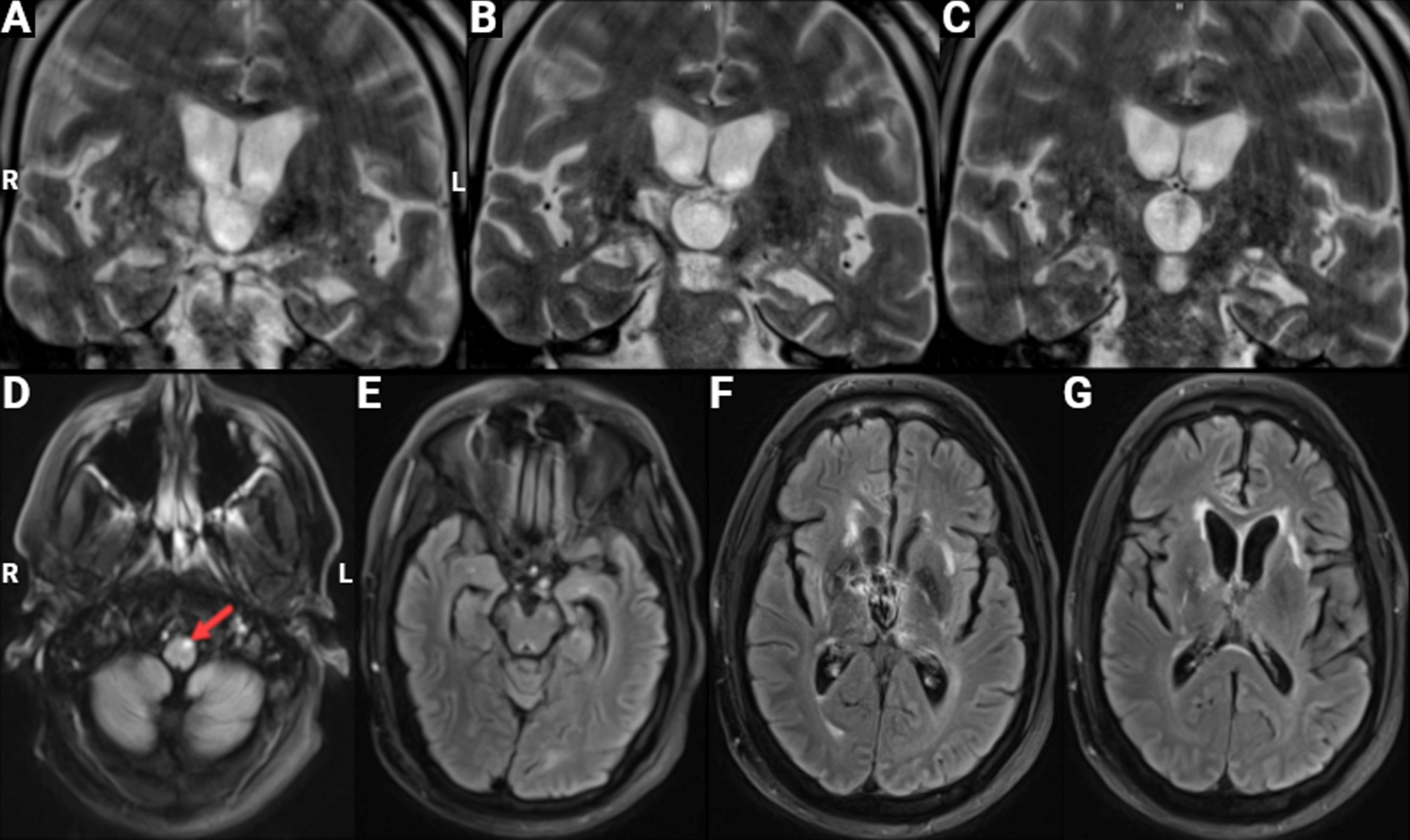 Brain MRI. Images from a February 2022 MRI scan are shown; the obtained images were mildly degraded by motion artifact. A-C) Coronal T2 high-resolution 3MM sequence depicting left greater than right hippocampal volume loss in the anterior, medial, and posterior hippocampus regions. There is also significant ex vacuo dilatation of the third ventricle. D-G) Axial T2 FLAIR BLADE sequence showing focal signal hyperintensity (arrow) in the pyramidal tract on the left (D), potentially reflective of Wallerian degeneration consequent to a past stroke or selective primary degeneration of upper motor neurons. There are small, chronic, bilateral signal changes thought to represent sequelae of subcortical infarcts in the anterior temporal (E), basal ganglia/thalamus (F), and internal capsule (G) regions.