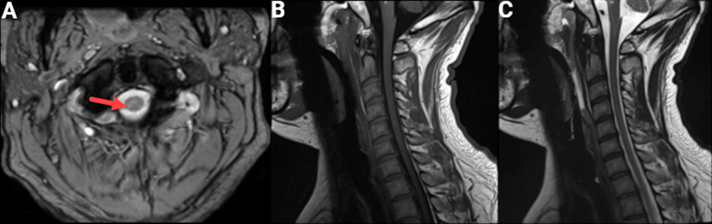 Cervical MRI. An MRI of the cervical spine and cord was obtained because of concomitant signs of central and peripheral motor system dysfunction at a cervical level. A) Axial GRE T2 sequence showing subtle T2 hyperintensity in the right (arrow) greater than left corticospinal tract. Sagittal T1 (B) and sagittal T2 (C) sequences without evidence of cord compression.