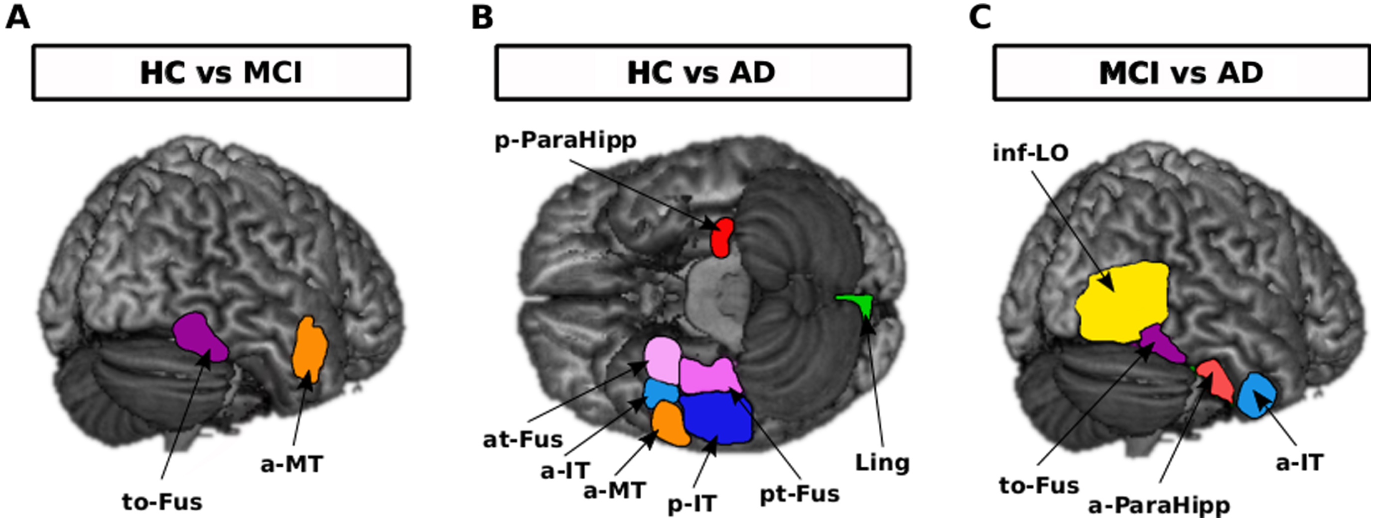 Brain activation differences in response to all images of animal and non-animal within regions of interest when comparing each two groups, uncorrected p-value< = 0.01. A) Right to-Fus and a-MT were more activated in the HC than in the MCI group. B) Left p-ParaHipp and right at-Fus, a-IT, a-MT, p-IT, pt-Fus and Ling were more activated in the HC than in the AD group. C) Right inf-LO, to-Fus, a-ParaHipp and a-IT were more activated in the MCI than in the AD group. to-Fus, temporal occipital fusiform cortex; at-Fus, temporal fusiform cortex, anterior division; pt-Fus, temporal fusiform cortex, posterior division; a-Mt, middle temporal gyrus, anterior division; a-IT, inferior temporal gyrus, anterior division; p-IT, inferior temporal gyrus, posterior division; p-ParaHipp, parahippocampal gyrus, posterior division; a-ParaHipp, parahippocampal gyrus, anterior division; Ling, lingual gyrus; inf-LO, lateral occipital cortex, inferior division. The only region that remained significant after FDR correction was right a-IT in HC versus AD comparison.