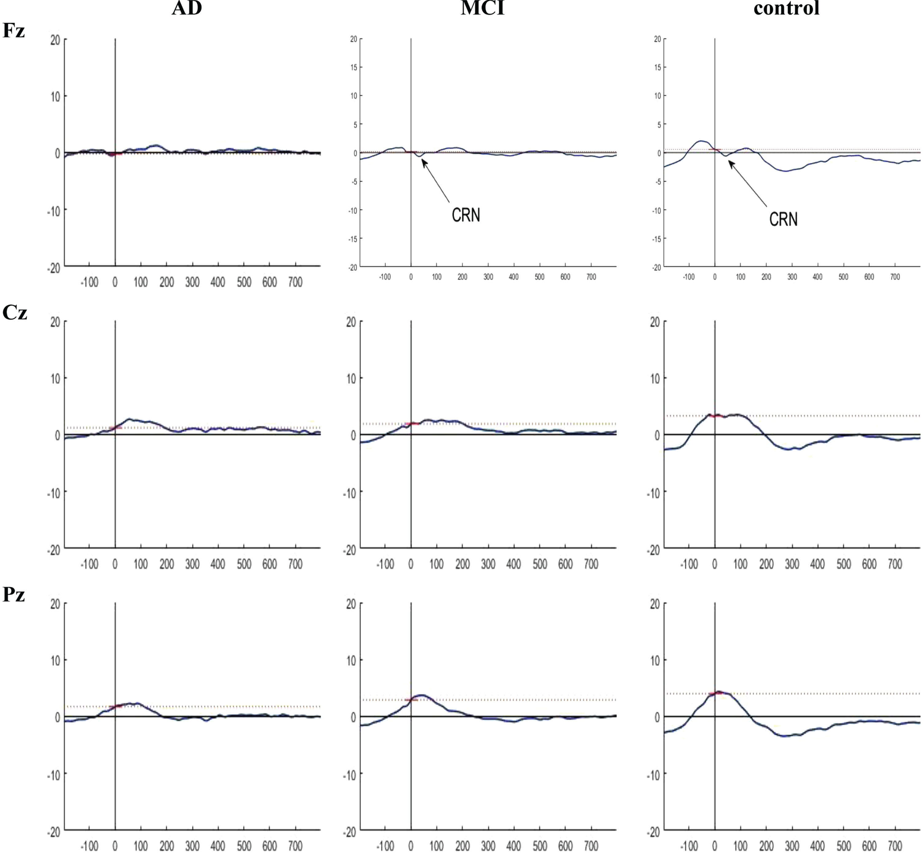 Grand averaged plots of ERPs time-locked to correct response obtained from 16 AD patients, 16 MCI patients, and 15 controls in Fz, Cz, and Pz channels. The peaks of CRN were visible in MCI and control groups in Fz and Cz channels but there is no difference in the CRN component between the groups in these channels.