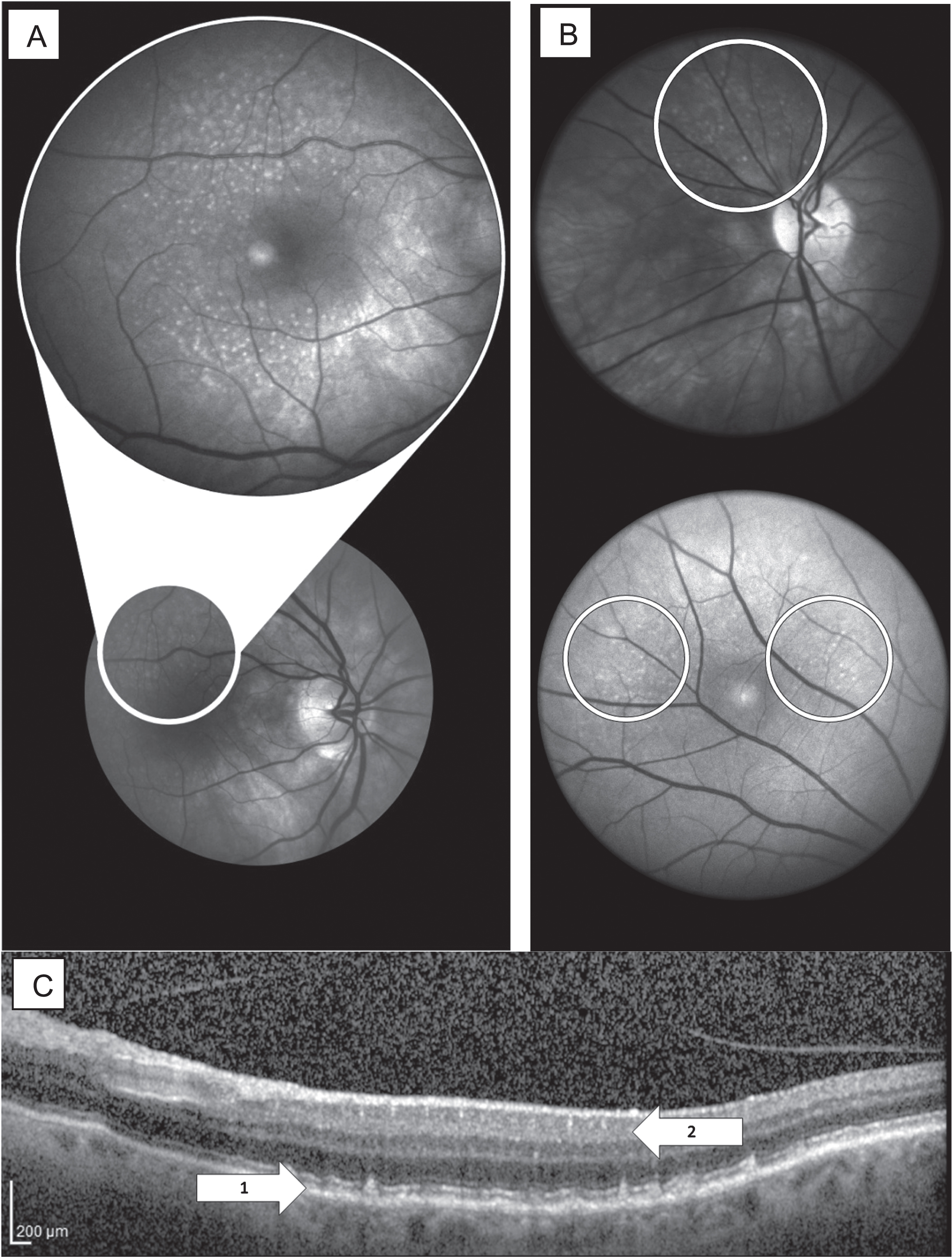 Presentation of deposits in retinal imaging. A) HSI of the retina at 575 nm displaying drusen deposits in the macular region. B) Examples of HSI between 450–580 nm showing deposits of interest outside of the macular region. C) OCT image illustrating drusen deposition in and between the RPE and Bruch’s membrane retinal layers (1). Note: According to literature, the layers of deposition for Aβ are in superior layers, including the RNFL, GCL, and IPL (2) [14], [54]. HSI, hyperspectral imaging; OCT, optical coherence tomography; RPE, retinal pigment epithelium; RNFL, retinal nerve fiber layer; GCL, ganglion cell layer; IPL, inner plexiform layer.