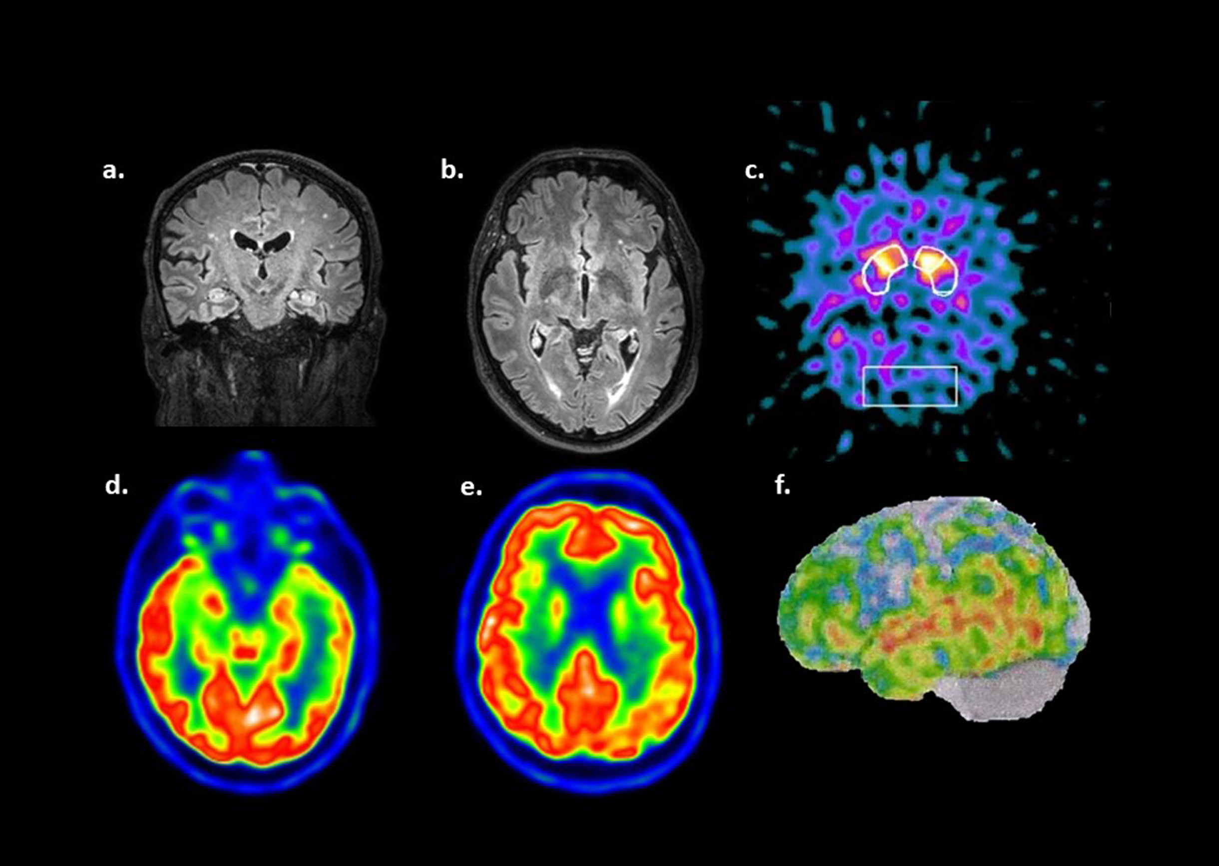 Cerebral MRI images (a, b). Fluid-attenuated inversion recovery (FLAIR) shows hyperintense lesions due to chronic small vessel disease, Fazekas Scale 1. Hippocampus and basal ganglia do not show abnormalities. 123I-FP-CIT dopamine transporter SPECT (c) revealed an inhomogeneous presynaptic dopamine transporter reduction in the putamen and caudates, with left-side and right-side predominance respectively. 18F-FDG PET imaging (d, e) demonstrated hypometabolism in both parietal lobes, most prominently on the left, and in the left lateral temporal area. [18F] Flutemetamol Amyloid PET showed predominant Aβ amyloid accumulation in the left temporal region (f).