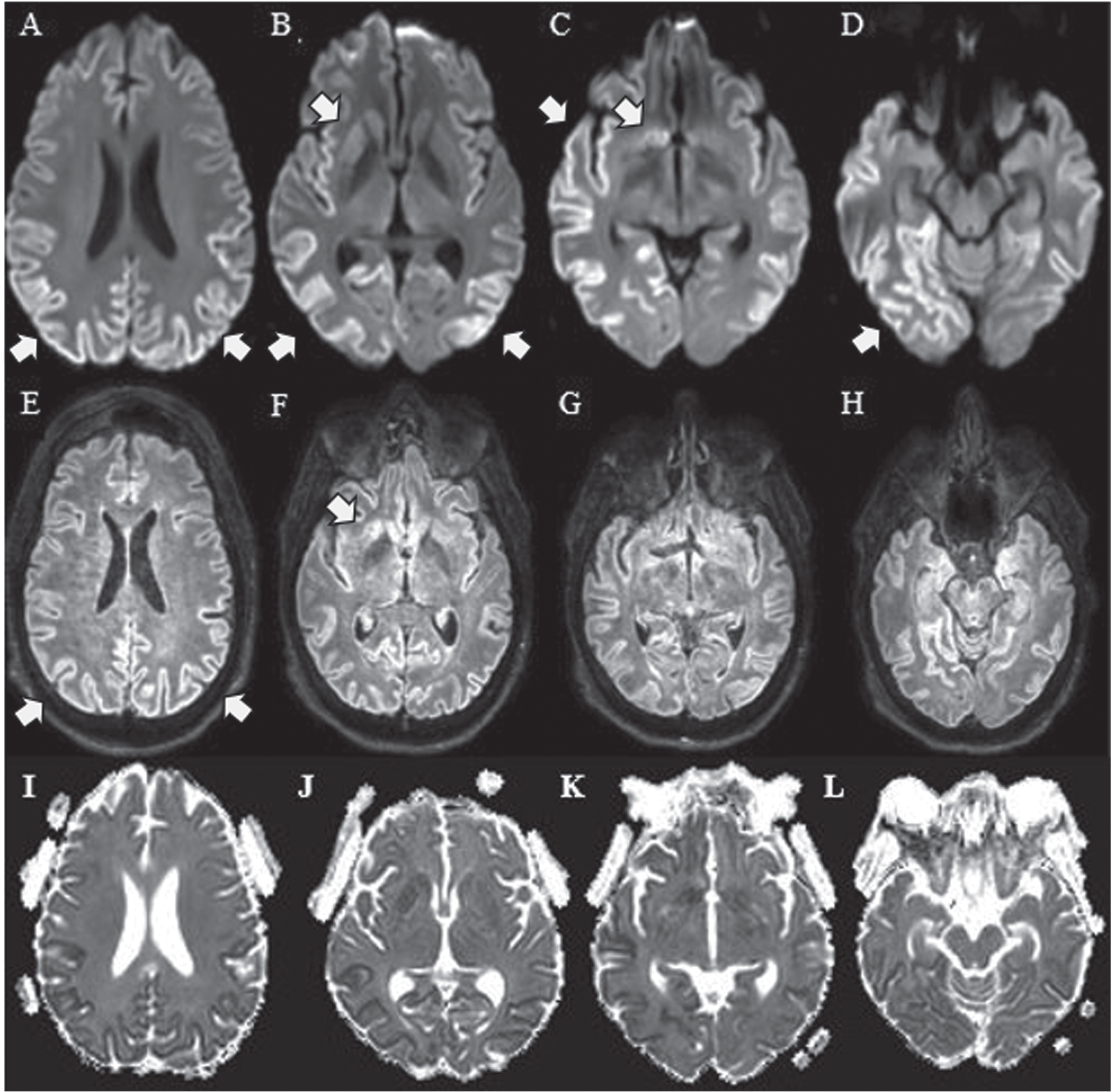 Multiple Axial DWI sequences from the patient’s brain MRI demonstrate abnormal signal hyperintensity (arrows) at several cortical locations (A, B, D) and in the caudate head on the diffusion-weighted sequence. (C) Less conspicuous signal hyperintensity is present at the corresponding locations on the fluid-attenuated inversion recovery (FLAIR) sequences (E, F, G, H). Apparent diffusion coefficient (ADC) corresponding sequences are shown in I, J, K and L.