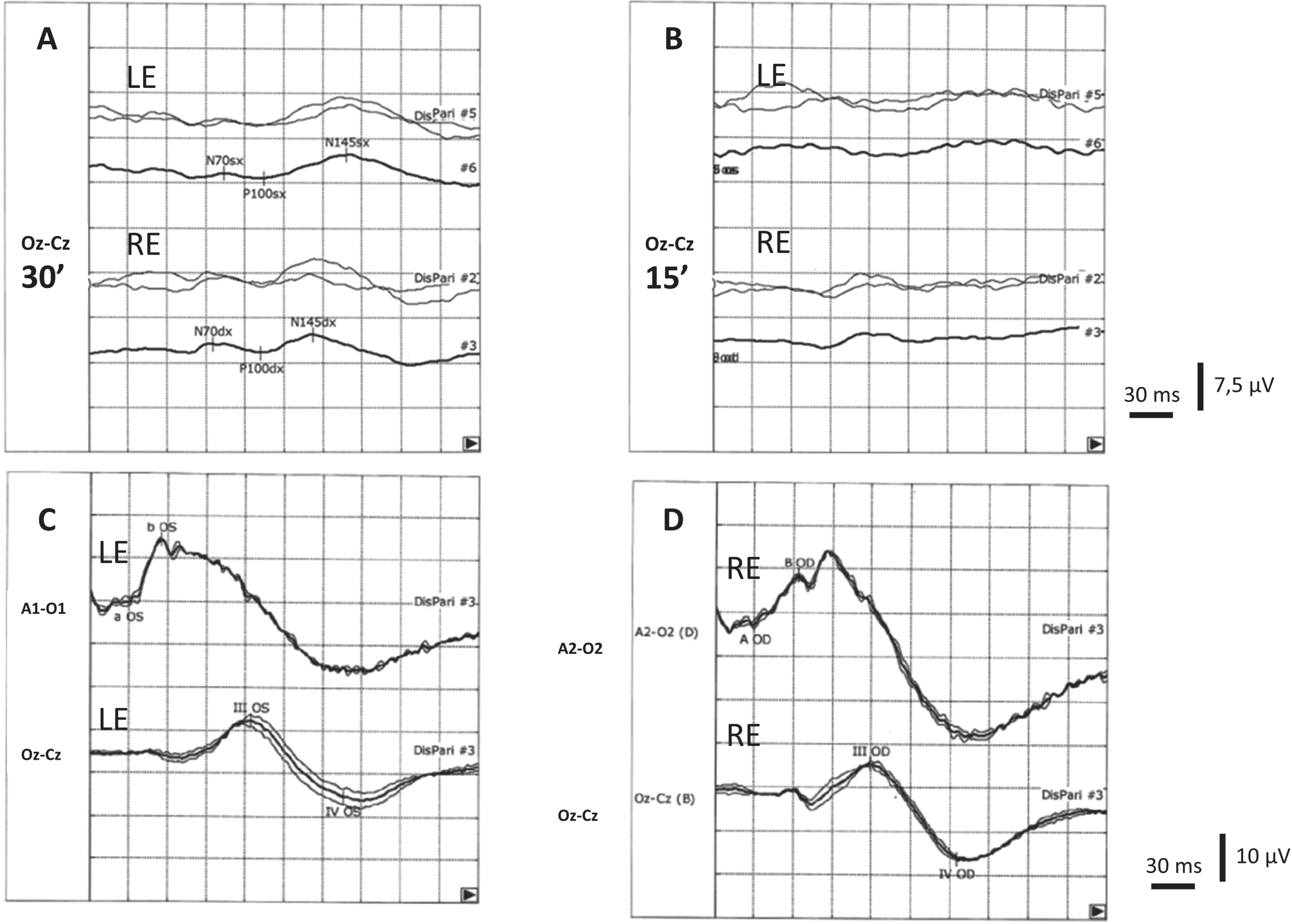 Visual evoked potentials (VEPs) performed by checkerboard pattern reversal stimuli system with 30’ (A) and 15’ (B) checks in our patient. All VEPs were recorded after monocular stimulation using Ag/AgCl skin electrodes placed accordingly to the 10–20 international system in Oz (active electrode) and Cz (reference electrode). Two series of 100 artifact-free responses were averaged for each check and each eye. The peak latency of the major positive wave (P100) was measured to the nearest millisecond. With 30’ checks the latency was 132 and 135 ms for right eye (RE) and left eye (LE) stimulation, respectively (upper normal limit: 118 ms), while the amplitude was 1.4μV and 0.8μV for right eye (RE) and left eye (LE) stimulation respectively (lower normal limit: 3μV). Cortical responses were non-recordable using the 15’ checks. Full-field electroretinogram (ERG) was recorded using flash stimulation of the LE (C) and RE (D) in mesopic condition by a Ag/AgCl a skin electrode placed over the ipsilateral ear lobe and reference electrode placed over the skin of the lower eyelid of the stimulated eye. Flash-induced VEPs (lower traces) were recorded by occipital surface electrode positioned as above said. III and IV waves were recordable after stimulation of both eyes.