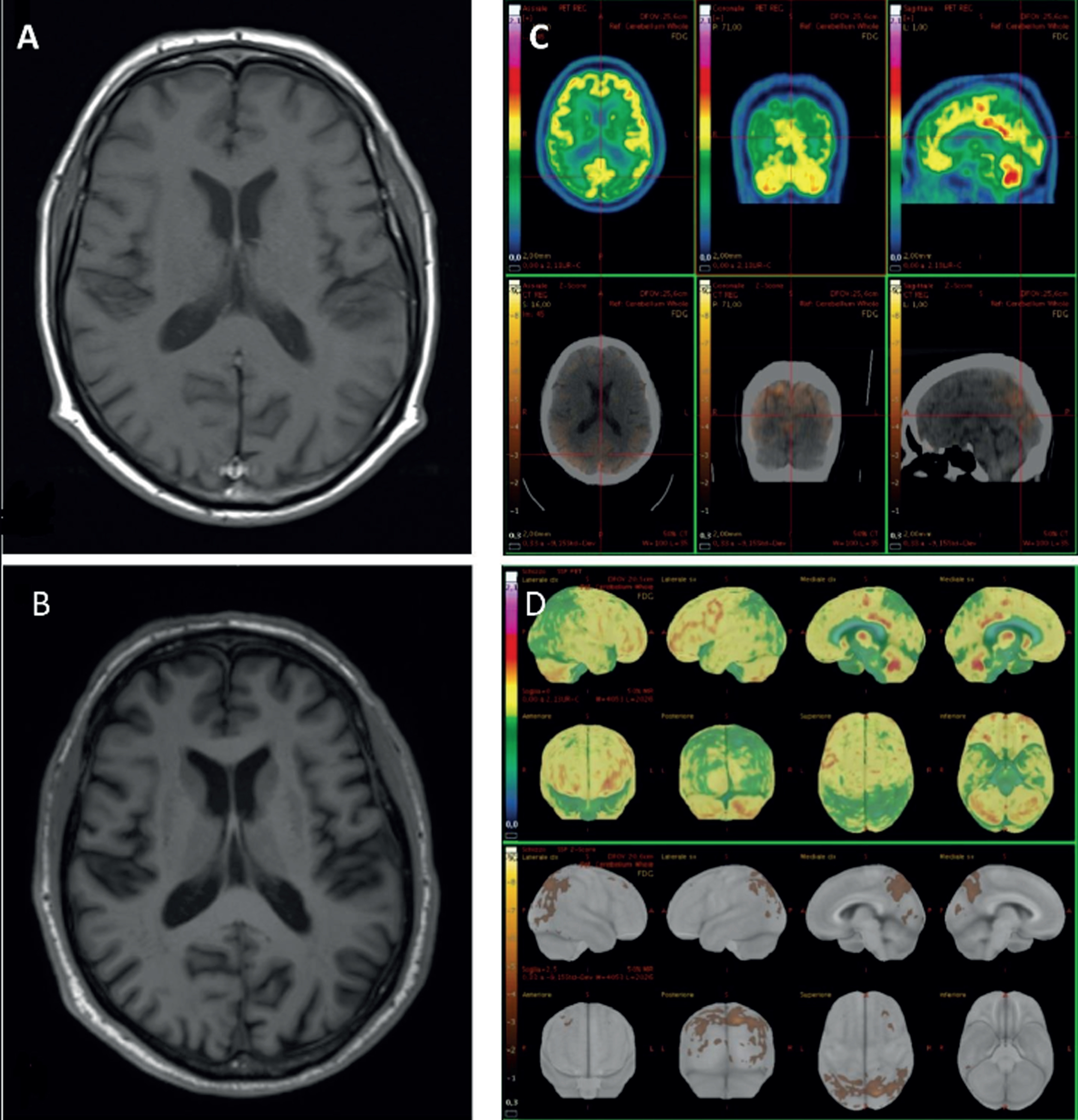 Magnetic resonance imaging (MRI) and fluorodeoxyglucose (FDG)-positron emission tomography (PET) images of our patient. MRI-3T T1w axial slice shows the worsening of parieto-occipital atrophy (A in 2021, B in 2022). FDG-PET axial, coronal, and sagittal slices with correspondent computed tomography slices (C). Z-score maps calculated from FDG-PET imagines exhibited a significant bilateral precuneus, parietal superior and occipital lateral hypometabolism (D).