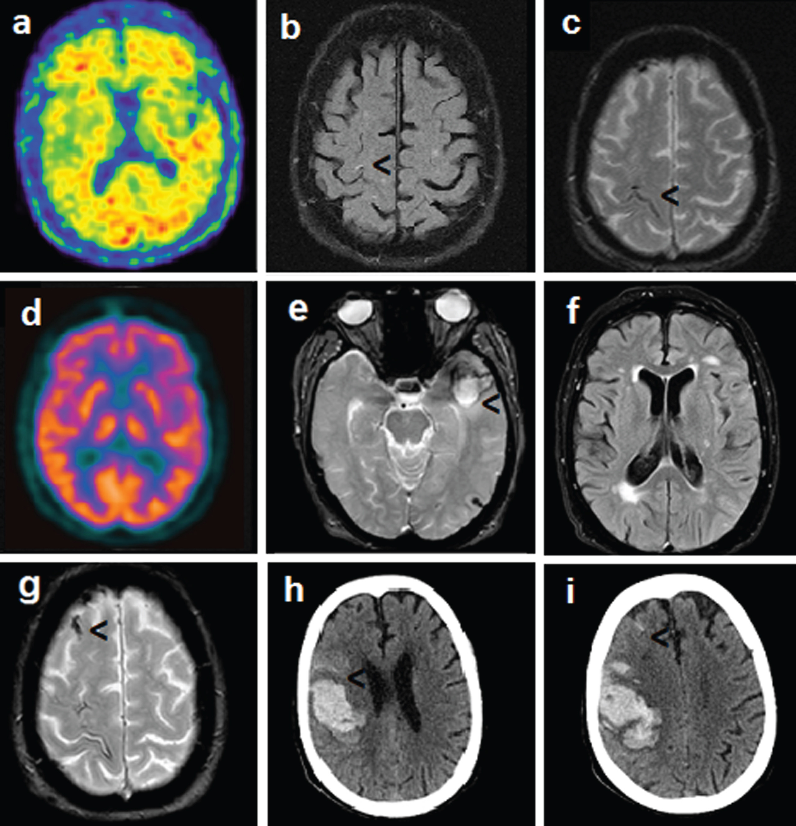 a) Florbetapir PET (age 79): amyloid presence in the brain. b) Brain MRI on T2 FLAIR WI (age 80): small hyperintensity in the right precentral lesion. c) Brain MRI on T2* WI (age 80): hemosiderin deposition along with the right Rolandic fissure. d) FDG-PET imaging (age 77): absence of AD-like pattern. e) Brain MRI on T2* WI (age 82): lobar hemorrhage in the left temporopolar region, cortical superficial siderosis in the left temporal sulcus. f) Brain MRI on T2 FLAIR WI (age 82): white matter hyperintensity. g) Brain MRI on T2*WI (age 82): cortical superficial siderosis in the right superior frontal sulcus. h, i) Brain CT (age 82): large hemorrhage on the right fronto-parietal region, small amount of subarachnoid hemorrhage. (Permission to share imaging was granted by the patient before death).