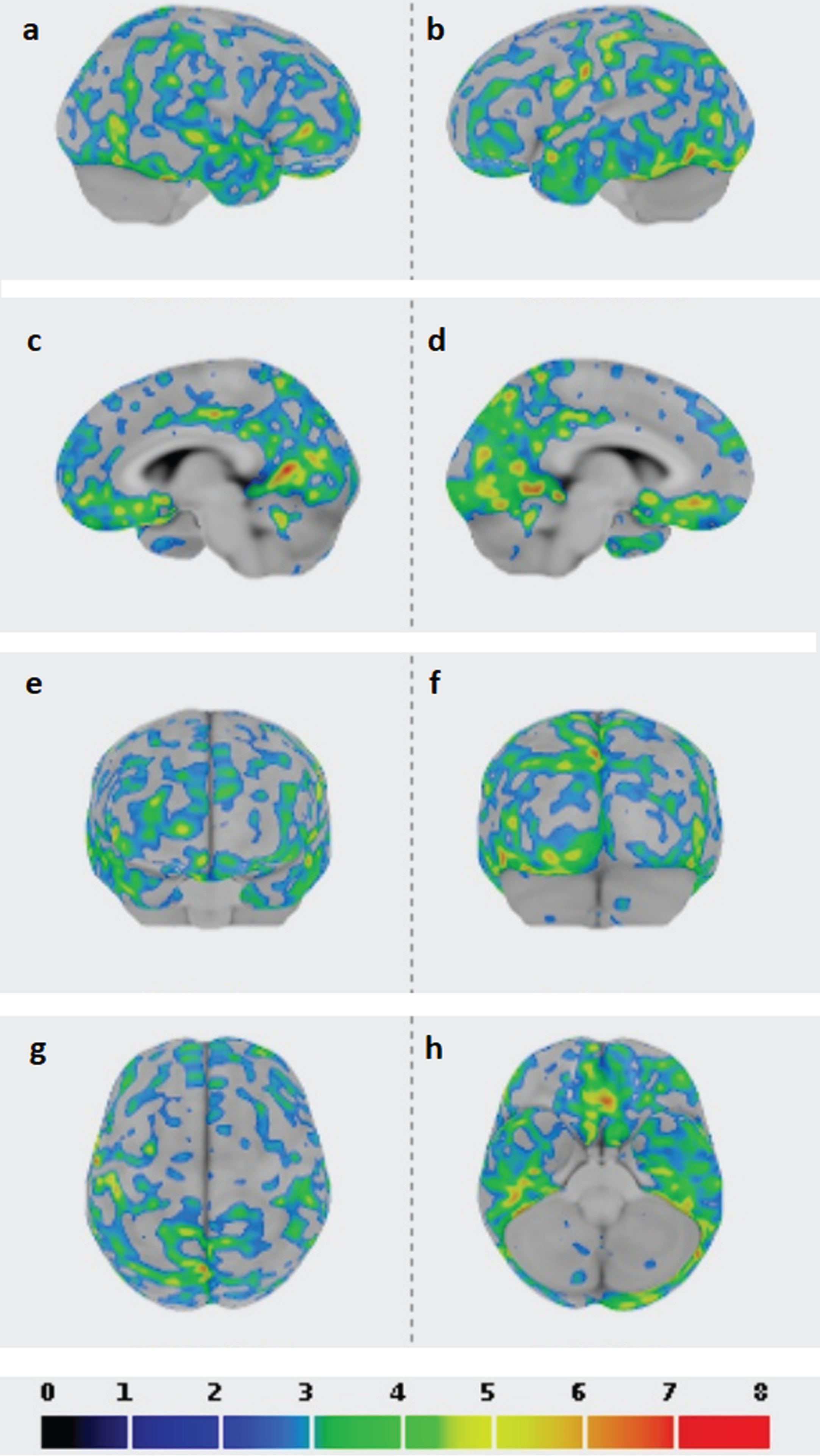 Z-SCORE images are shown with a dedicated color table at the bottom of the figure (from 0 to 8), a threshold of 2 SD applied to the images; cerebellum whole as reference region in the ROI analysis performed with CortexID software; higher Z-score and standardized uptake value ratio (SUVR) for the occipital regions. a) right lateral view; b) left lateral view; c) right medial view; d) left medial view; e) anterior view; f) posterior view; g) superior view; h) inferior view.