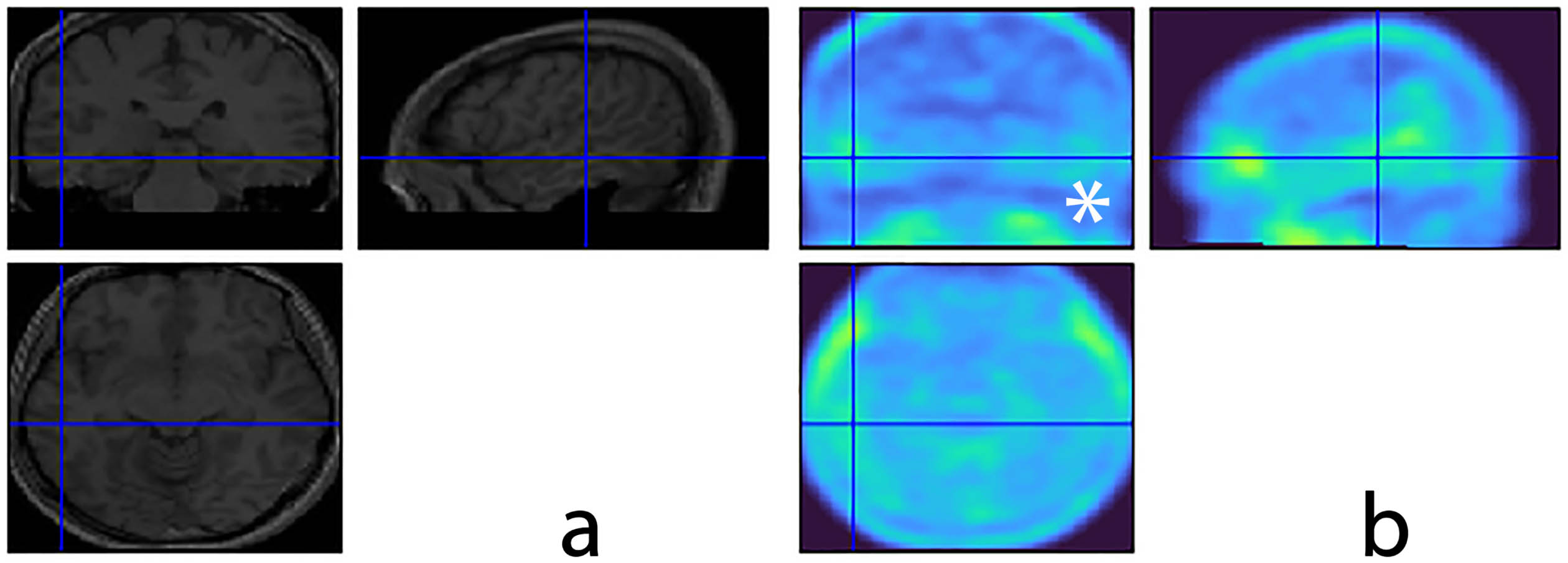 Exemplification case 6. Template MRI in (a) and co-registered PET tau imaging in (b) show a mild burden of tau protein in the right temporal lobe (blue cross). To note that a very mild uptake, slightly superior to the background, is detectable in the left temporal lobe as well (b, white asterisk).