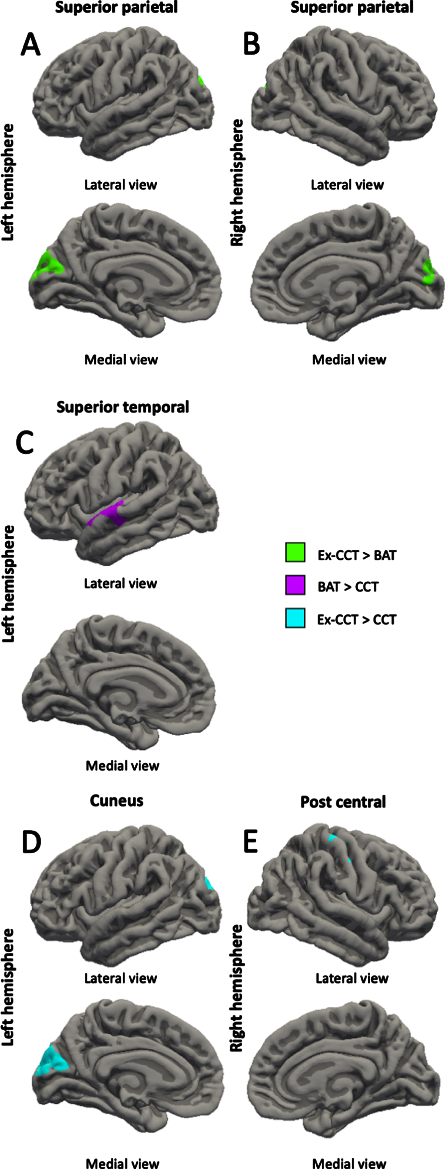 Between-group differences (α< 0.05) in: A) left superior parietal thickness; B) right superior parietal thickness; C) left superior temporal thickness; D) left cuneus thickness; and E) right post central thickness, controlling for age, sex, and MoCA.