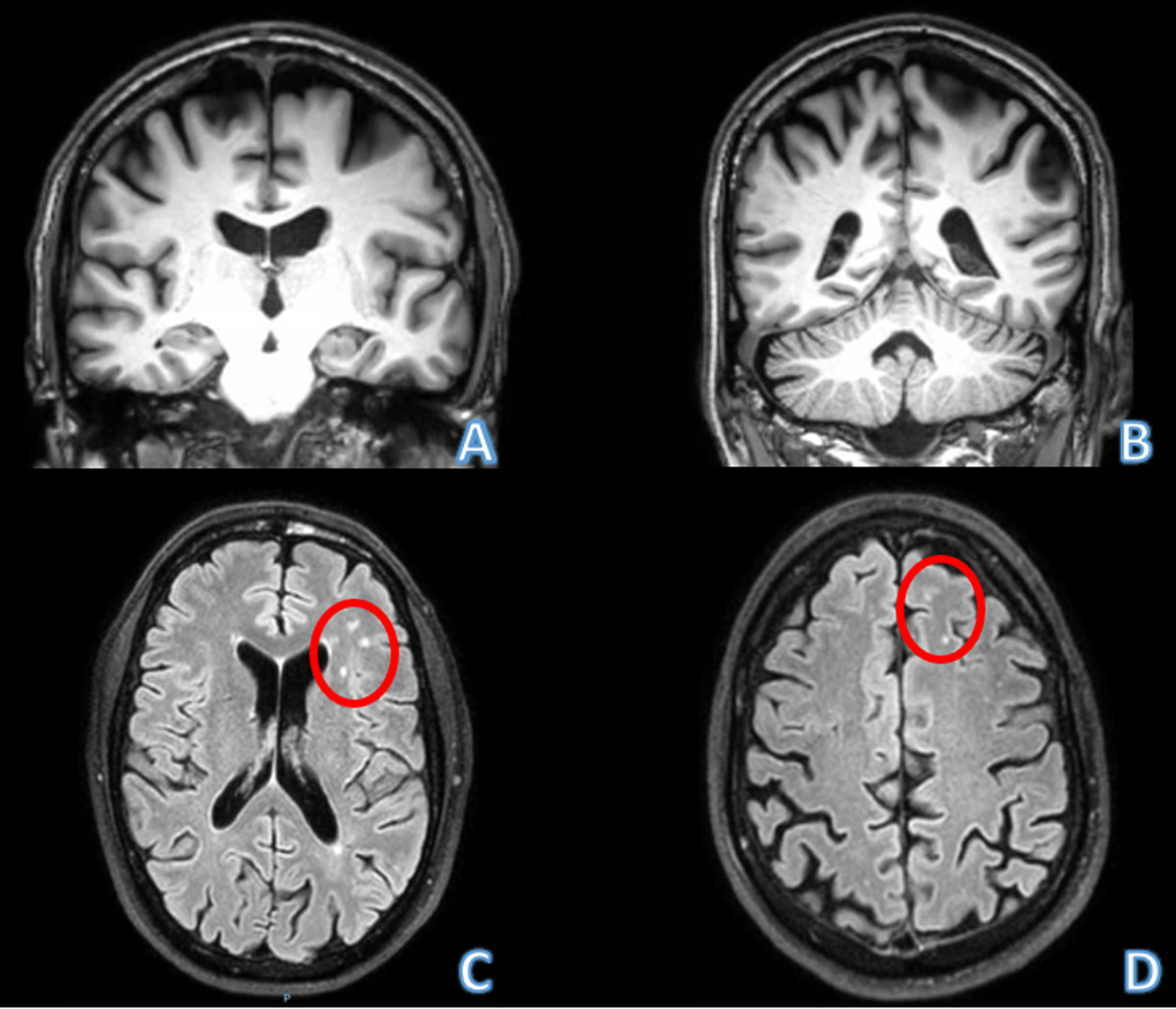 Brain MRI of the patient. A, B) Coronal sections in the T1 sequence. Note predominantly parietal atrophy, but relatively spare of both hippocampi. C, D) Axial section in FLAIR sequence. Note the hyperintensities in white matter possibly related with microglial activation described in patients with progranulin mutation (red circles).