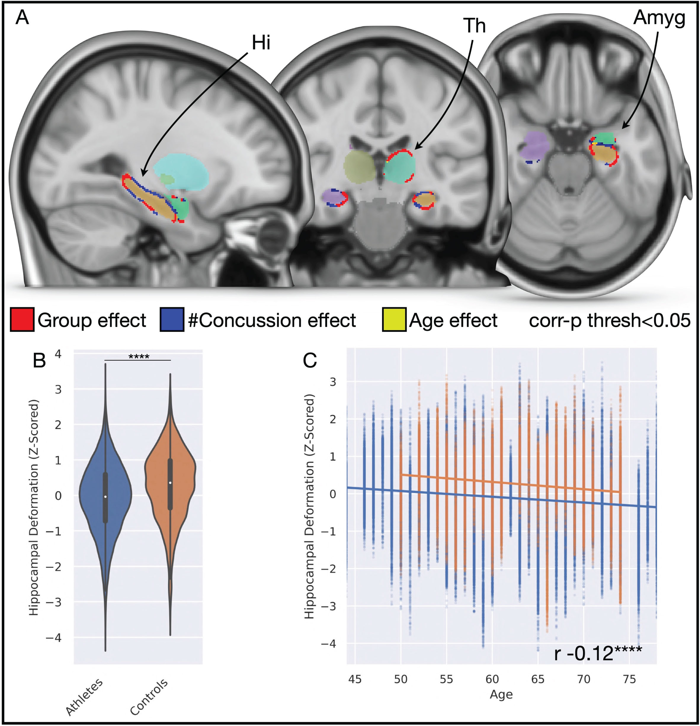 Subcortical shape and appearance differences across the cohort. A) Brain slices illustrate significant differences in morphology of the hippocampus bilaterally, the left thalamus, and left amygdala with associations to group (red), the number of concussions (blue), and age (yellow). B) Violin plot illustrates bilateral hippocampal shape deformation significantly favors inward deformation in the athlete group, compared to controls. C) Scatterplot with linear regression illustrates that hippocampal shape significantly tends to inward deformation with increasing age in both groups, but that the gradient decline is not significantly different between groups, indicative that findings are not merely driven by a function of age. Amyg, amygdala; Hi, hippocampus; Th, thalamus.